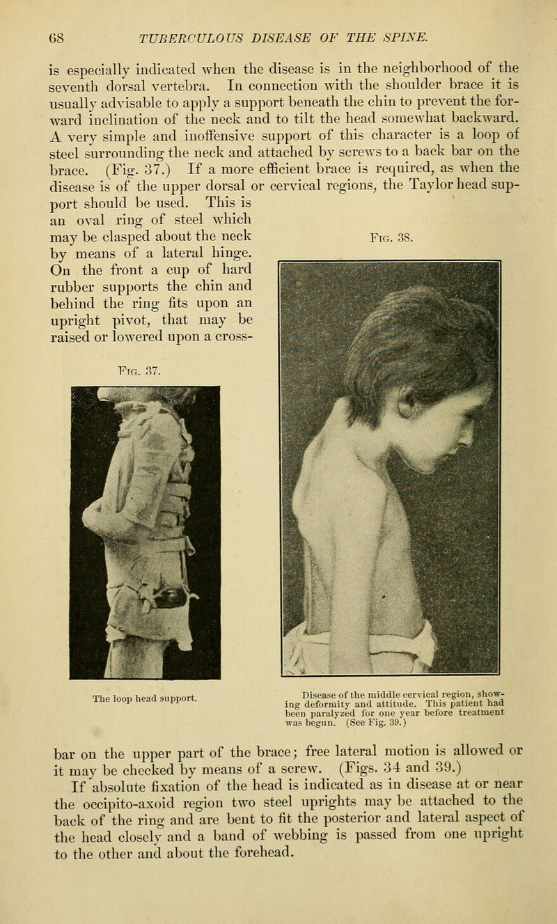 is especially indicated when the disease is in the neighborhood of the seventh dorsal vertebra. In connection with the shonlder brace it is usually advisable to apply a support beneath the chin to prevent the for- ward inclination of the neck and to tilt the head somewhat backward. A very simple and inoflPensive support of this character is a loop of steel surrounding the neck and attached by screws to a back bar on the brace. (Fig. 37.) If a more efBcient brace is required, as when the disease is of the upper dorsal or cervical regions, the Taylor head sup- port should be used. This is an oval ring of steel which may be clasped about the neck Ficx. 38. by means of a lateral hinge. On the front a cup of hard rubber supports the chin and behind the ring fits upon an upright pivot, that may be raised or lowered upon a cross- Ftg. 37. The loop head support. Disease of the middle cervical regioB, show- ing deformity and attitude. This patient had been paralyzed for one year before treatment ■was begun. (See Fig. 39.) bar on the upper part of the brace; free lateral motion is allowed or it may be checked by means of a screw. (Figs. 34 and 39.) If absolute fixation of the head is indicated as in disease at or near the occipito-axoid region two steel uprights may be attached to the back of the ring and are bent to fit the posterior and lateral aspect of the head closely and a band of webbing is passed from one upright to the other and about the forehead.