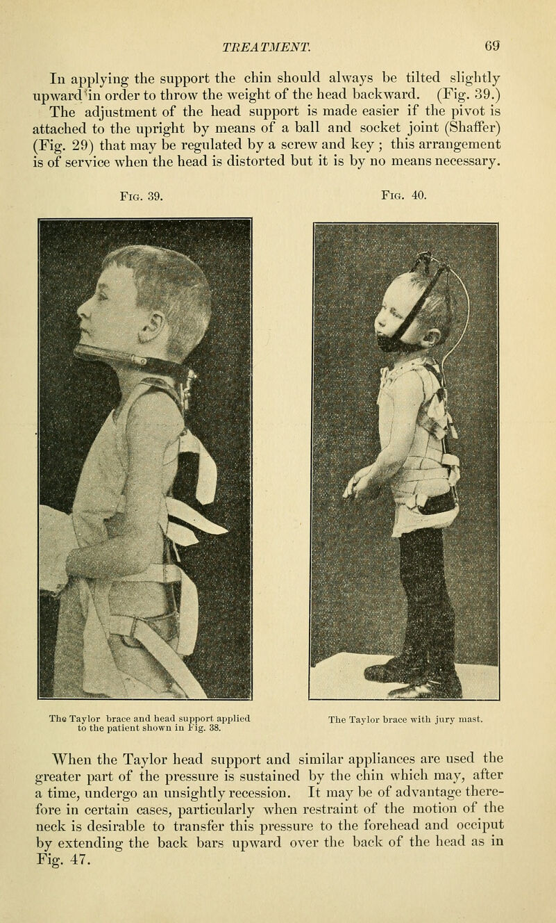In applying the support the chin should always be tilted slightly upward'in order to throw the weight of the head backward. (Fig. 39.) The adjustment of the head support is made easier if the pivot is attached to the upright by means of a ball and socket joint (Shaffer) (Fig. 29) that may be regulated by a screw and key ; this arrangement is of service when the head is distorted but it is by no means necessary. Fig. 39. FiCx. 40. The Taylor brace and head support, applied to the patient shown in Fig. 38. The Taylor brace with jury mast. When the Taylor head support and similar appliances are used the greater part of the pressure is sustained by the chin which may, after a time, undergo an unsightly recession. It may be of advantage there- fore in certain cases, particularly when restraint of the motion of the neck is desirable to transfer this pressure to the forehead and occiput by extending the back bars upward over the back of the head as in