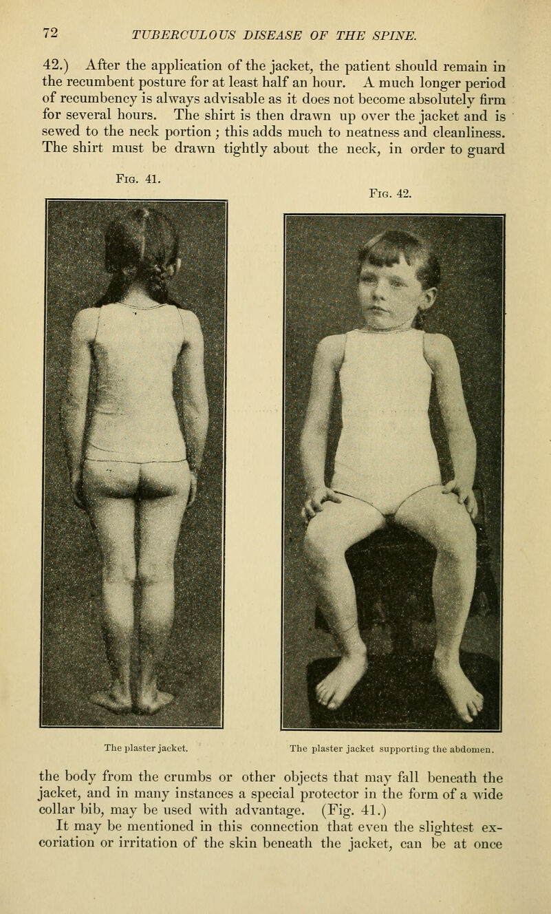 42.) After the application of the jacket, the patient should remain in the recumbent posture for at least half an hour. A much longer period of recumbency is always advisable as it does not become absolutely firm for several hours. The shirt is then drawn up over the jacket and is sewed to the neck portion ; this adds much to neatness and cleanliness. The shirt must be drawn tightly about the neck, in order to guard Fig. 41. Fig. 42. The plaster jacket. The plaster jacket suiiporting the abdomen. the body from the crumbs or other objects that may fall beneath the jacket, and in many instances a special protector in the form of a wide collar bib, may be used with advantage. (Fig. 41.) It may be mentioned in this connection that even the slightest ex- coriation or irritation of the skin beneath tlie jacket, can be at once