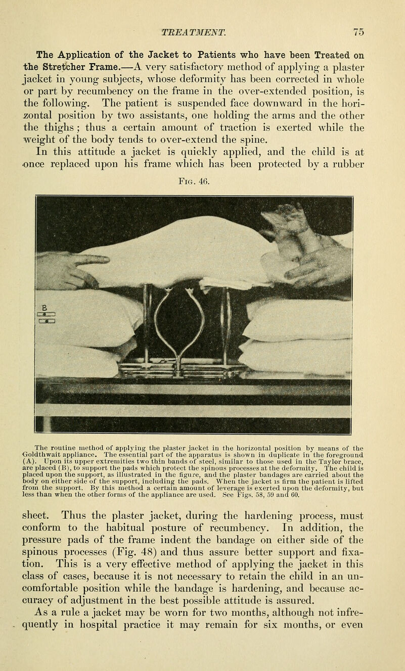 The Application of the Jacket to Patients who have been Treated on the Stretcher Frame.—A very satisfactory method of applying a plaster jacket in young subjects^ whose deformity has been corrected in whole or part by recumbency on the frame in the over-extended position, is the following. The patient is suspended face downward in the hori- -zontal position by two assistants, one holding the arms and the other the thighs; thus a certain amount of traction is exerted while the weight of the body tends to over-extend the spine. In this attitude a jacket is quickly applied, and the child is at once replaced upon his frame which has been protected by a rubber Fig. 46. The routine method of applying the plaster jacket in the horizontal position by means of the Ooldthwait appliance. The essential part of the apparatus is shown in duplicate in the foreground (A). Upon its upper extremities two thin bands of steel, similar to those used in the Taylor brace, are placed (B), to support the pads which protect the spinous processes at the deformity. The child is placed upon the support, as illustrated in the figure, and the plaster bandages are carried about the body on either side of the support, including the pads. When the jacket is Arm the patient is lifted from the support. By this method a certain amount of leverage is exerted upon the deformity, but less than when the other forms of the appliance are used. See Figs. 58, 59 and 60. sheet. Thus the plaster jacket, during the hardening process, must conform to the habitual posture of recumbency. In addition, the pressure pads of the frame indent the bandage on either side of the spinous processes (Fig. 48) and thus assure better support and fixa- tion. This is a very effective method of applying the jacket in this class of cases, because it is not necessary to retain the child in an un- comfortable position while the bandage is hardening, and because ac- curacy of adjustment in the best possible attitude is assured. As a rule a jacket may be worn for two months, although not infre- quently in hospital practice it may remain for six months, or even