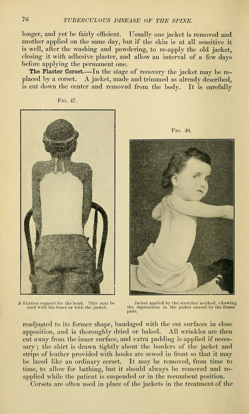 longer, and yet be fairly efficient. Usually one jacket is removed and another applied on the same day, but if the skin is at all sensitive it is well, after the washing and powdering, to re-apply the old jacket, closing it with adhesive plaster, and allow an interval of a few days before applying the permanent one. The Plaster Corset.—In the stage of recovery the jacket may be re- placed by a corset. A jacket, made and trimmed as already described, is cut down the center and removed from the body. It is carefully Fig. 47. Fig. 48. A fixation support for the head. This may be used with tlie brace or with the jacket. Jacket applied by the stretcher method, showing the depressions in the jacket caused by the frame pads. readjusted to its former shape, bandaged with the cut surfaces in close apposition, and is thoroughly dried or baked. All wrinkles are then cut away from the inner surface, and extra padding is applied if neces- sary ; the shirt is drawn tightly about the borders of the jacket and strips of leather provided with hooks are sewed in front so that it may be laced like an ordinary corset. It may be removed, from time to time, to allow for bathing, but it should always be removed and re- applied while the patient is suspended or in the recumbent position. Corsets are often used in place of the jackets in the treatment of the