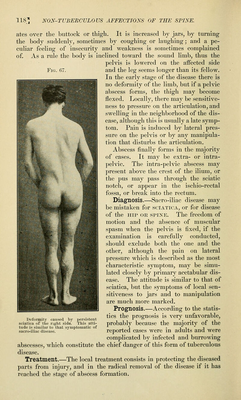 Fig. 67. ates over the buttock or thigh. It is increased by jars, by turning the body suddenly, sometimes by coughing or laughing; and a pe- culiar feeling of insecurity and weakness is sometimes complained of. As a rule the body is inclined toward the sound limb, thus the pelvis is lowered on the aifected side and the leg seems longer than its fellow. In the early stage of the disease there is no deformity of the limb, but if a pelvic abscess forms, the thigh may become flexed. Locally, there may be sensitive- ness to pressure on the articulation, and swelling in the neighborhood of the dis- ease, although this is usually a late symp- tom. Pain is induced by lateral pres- sure on the pelvis or by any manipula- tion that disturbs the articulation. Abscess finally forms in the majority of cases. It may be extra- or intra- pelvic. The intra-pelvic abscess may present above the crest of the ilium, or the pus may pass through the sciatic notch, or appear in the ischio-rectal fossa, or break into the rectum. Diagnosis.—Sacro-iliac disease may be mistaken for SCIATICA, or for disease of the HIP OR SPINE. The freedom of motion and the absence of muscular spasm when the pelvis is fixed, if the examination is carefully conducted, should exclude both the one and the other, although the pain on lateral pressure which is described as the most characteristic symptom, may be simu- lated closely by primary acetabular dis- ease. The attitude is similar to that of sciatica, but the symptoms of local sen- sitiveness to jars and to manipulation are much more marked. Prognosis.—According to the statis- tics the prognosis is very unfavorable, probably because the majority of the reported cases were in adults and were complicated by infected and burrowing abscesses, which constitute the chief danger of this form of tuberculous disease. Treatment.—The local treatment consists in protecting the diseased parts from injury, and in the radical removal of the disease if it has reached the stae-e of abscess formation. Deformity caused by persistent sciatica of the right side. This atti- tude is similar to that symptomiatic of sacro-iliac disease.