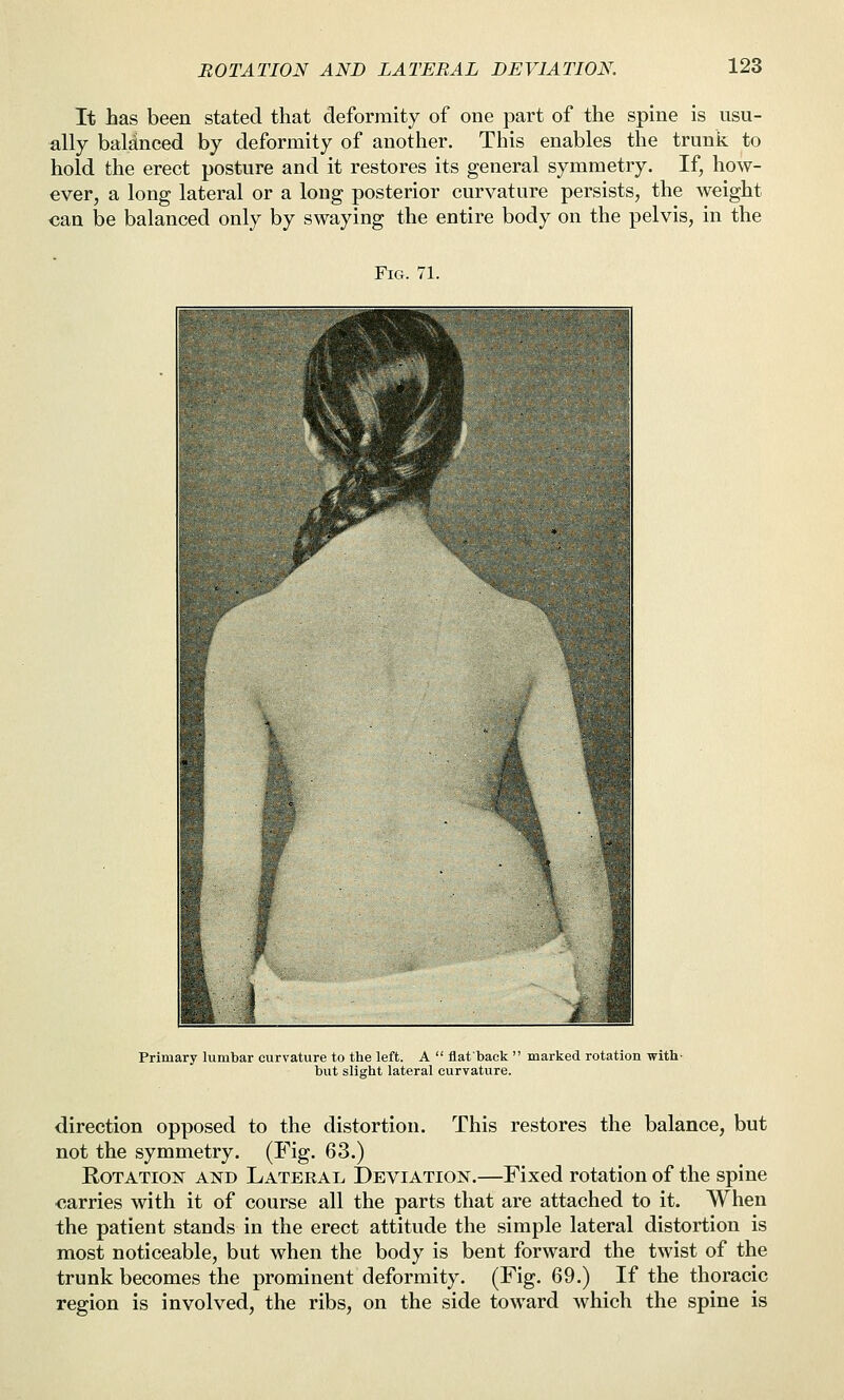 ROTATION AND LATERAL DEVIATION. It Jaas been stated that deformity of one part of the spine is usu- ally baldnced by deformity of another. This enables the trunk to hold the erect posture and it restores its general symmetry. If, how- ever, a long lateral or a long posterior curvature persists, the weight <;an be balanced only by swaying the entire body on the pelvis, in the Fig. 71. Primary lumbar curvature to the left. A  flat'back ' but slight lateral curvature. marked rotation with- direction opposed to the distortion. This restores the balance, but not the symmetry. (Fig. 63.) Rotation and Lateral Deviation.—Fixed rotation of the spine carries with it of course all the parts that are attached to it. When the patient stands in the erect attitude the simple lateral distortion is most noticeable, but when the body is bent forward the twist of the trunk becomes the prominent deformity. (Fig. 69.) If the thoracic region is involved, the ribs, on the side toward which the spine is