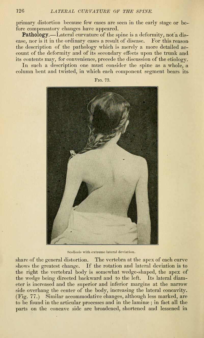 primary distortion because few cases are seen in the early stage or be- fore compensatory changes have appeared. Pathology.—Lateral curvature of the spine is a deformity, not'a dis- ease, nor is it in the ordinary cases a result of disease. For this reasou the description of the pathology which is merely a more detailed ac- count of the deformity and of its secondary effects upon the trunk and its contents may, for convenience, precede the discussion of the etiology. In such a description one must consider the spine as a whole, a column bent and twisted, in which each component segment bears its- Fig. 73. Scoliosis with extreme lateral deviation. share of the general distortion. The vertebra at the apex of each curve shows the greatest change. If the rotation and lateral deviation is to the right the vertebral body is somewhat wedge-shaped, the apex of the wedge being directed backward and to the left. Its lateral diam- eter is increased and the superior and inferior margins at the narrow side overhang the center of the body, increasing the lateral concavity. (Fig. 77.) Similar accommodative changes, although less marked, are to be found in the articular processes and in the laminae ; in fact all the parts on the concave side are broadened, shortened and lessened in