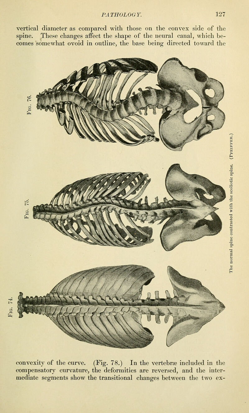 vertical diameter as compared with those on the convex side of the spine. These changes affect the shape of the neural canal, which be- comes somewhat ovoid in outline, the base being directed toward the , ,\V^A^\;- convexity of the curve. (Fig. 78.) In the vertebrae included in the compensatory curvature, the deformities are reversed, and the inter- mediate segments show the transitional changes between the two ex-