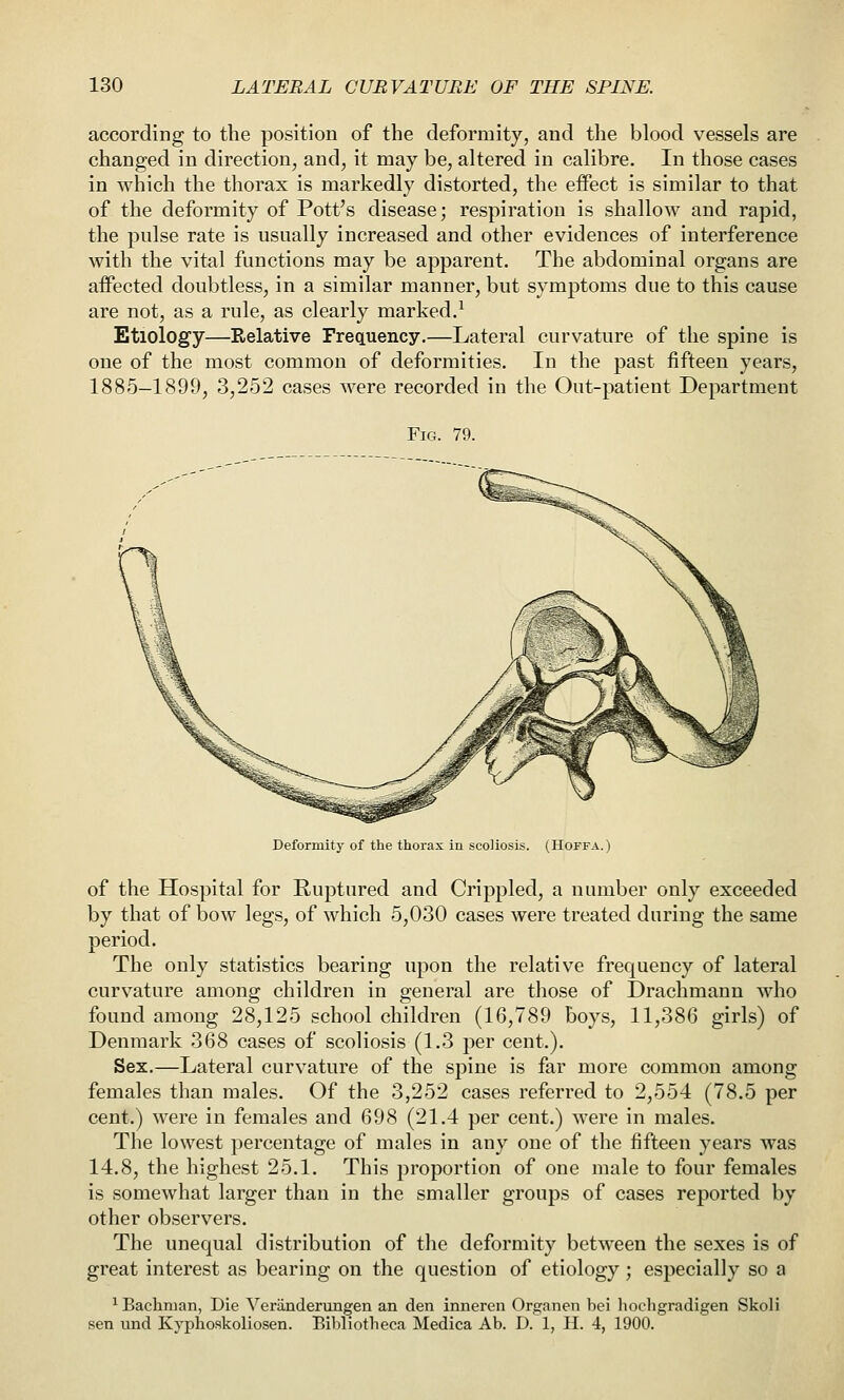 according to the position of the deformity, and the blood vessels are changed in direction, and, it may be, altered in calibre. In those cases in which the thorax is markedly distorted, the effect is similar to that of the deformity of Pott's disease; respiration is shallow and rapid, the pulse rate is usually increased and other evidences of interference with the vital functions may be apparent. The abdominal organs are affected doubtless, in a similar manner, but symptoms due to this cause are not, as a rule, as clearly marked.^ Etiology—Relative Frequency.—Lateral curvature of the spine is one of the most common of deformities. In the past fifteen years, 1885-1899, 3,252 cases were recorded in the Out-patient Department Fig. 79. Deformity of the thorax in scoliosis. (Hoffa.) of the Hospital for Ruptured and Crippled, a number only exceeded by that of bow legs, of which 5,030 cases were treated during the same period. The only statistics bearing upon the relative frequency of lateral curvature among children in general are those of Drachmann who found among 28,125 school children (16,789 boys, 11,386 girls) of Denmark 368 cases of scoliosis (1.3 per cent.). Sex.—Lateral curvature of the spine is far more common among females than males. Of the 3,252 cases referred to 2,554 (78.5 per cent.) were in females and 698 (21.4 per cent.) were in males. The lowest percentage of males in any one of the fifteen years was 14.8, the highest 25.1. This proportion of one male to four females is somewhat larger than in the smaller groups of cases reported by other observers. The unequal distribution of the deformity between the sexes is of great interest as bearing on the question of etiology; especially so a ^ Bachnian, Die Veranderungen an den inneren Organen bei liocligradigen Skoli sen und Kyphoskoliosen. Eibliotlieca Medica Ab. D. 1, H. 4, 1900.