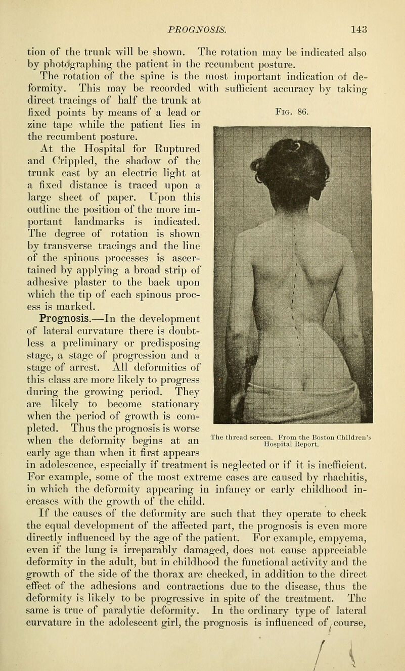 Fig. tion of the trunk will be shown. The rotation may be indicated also by photdgraphing the patient in the recumbent posture. The rotation of the spine is the most important indication of de- formity. This may be recorded with sufficient accuracy by taking direct tracings of half the trunk at fixed points by means of a lead or zinc tape while the patient lies in the recumbent posture. At the Hospital for Ruptured and Crippled, the shadow of the trunk cast by an electric light at a fixed distance is traced upon a large sheet of paper. Upon this outline the position of the more im- portant landmarks is indicated. The degree of rotation is shown by transverse tracings and the line of the spinous processes is ascer- tained by applying a broad strip of adhesive plaster to the back upon which the tip of each spinous proc- ess is marked. Prognosis.—In the development of lateral curvature there is doubt- less a preliminary or predisposing stage^ a stage of progression and a stage of arrest. All deformities of this class are more likely to progress during the growing period. They are likely to become stationary when the period of growth is com- pleted. Thus the prognosis is worse when the deformity begins at an early age than when it first appears in adolescence, especially if treatment is neglected or if it is inefficient. For example, some of the most extreme cases are caused by rhachitis, in which the deformity appearing in infancy or early childhood in- creases with the growth of the child. If the causes of the deformity are such that they operate to check the equal development of the affected part, the prognosis is even more directly influenced by the age of the patient. For example, empyema, even if the lung is irreparably damaged, does not cause appreciable deformity in the adult, but in childhood the functional activity and the growth of the side of the thorax are checked, in addition to the direct effect of the adhesions and contractions due to the disease, thus the deformity is likely to be progressive in spite of the treatment. The same is true of paralytic deformity. In the ordinary type of lateral curvature in the adolescent girl, the prognosis is influenced of course, The thread screen. From the Bonton ( hildreii's Hospital Report. / i