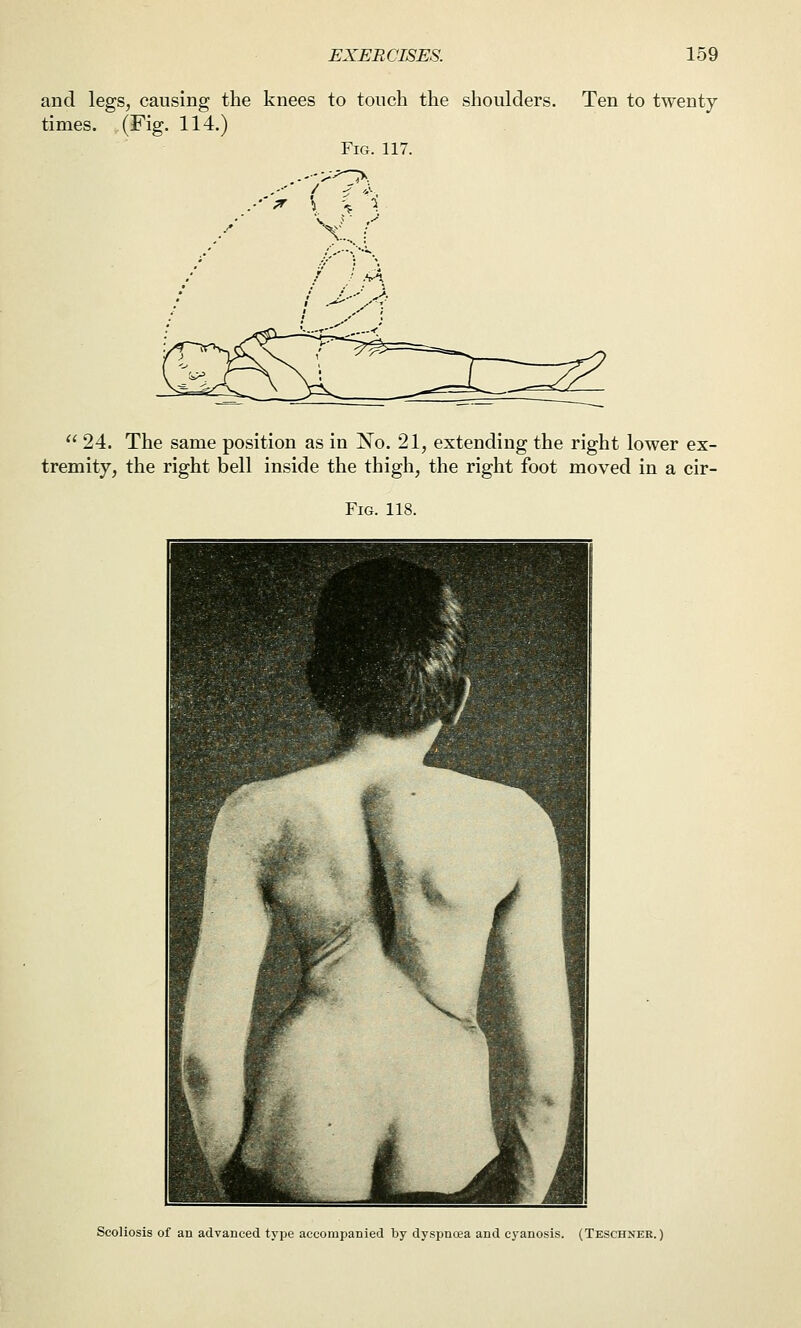 and legs, causing the knees to touch the shoulders. Ten to twenty times. (Fig. 114.) Fig. 117. ..•-;r \  24. The same position as in IS^o. 21, extending the right lower ex- tremity, the right bell inside the thigh, the right foot moved in a cir- FiG. 118. Scoliosis of an advanced type accompanied by dyspnoea and cyanosis. (Teschner. )