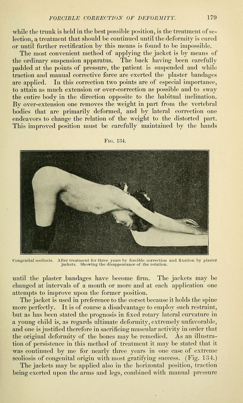 while the trunk is held in the best possible position, is the treatment of se- lection, a; treatment that should be continued until the deformity is cured or until further rectification by this means is found to be impossible. The most convenient method of applying the jacket is by means of the ordinary suspension apparatus. The back having been carefully padded at the points of pressure, the patient is suspended and while traction and manual corrective force are exerted the plaster bandages are applied. In this correction two points are of especial importance, to attain as much extension or over-correction as possible and to sway the entire body in the direction opposite to the habitual inclination. By over-extension one removes the weight in part from the vertebral bodies that are primarily deformed, and by lateral correction one endeavors to change the relation of the weight to the distorted part. This improved position must be carefully maintained by the hands Fig. 134. Congenital scoliosis. After treatment for three years by forcible correction and fixation by plaster jackets. Showing the disappearance of the rotation. until the plaster bandages have become firm. The jackets may be changed at intervals of a month or more and at each application one attempts to improve upon the former position. The jacket is used in preference to the corset because it holds the spine more perfectly. It is of course a disadvantage to employ such restraint, but as has been stated the prognosis in fixed rotary lateral curvature in a young child is, as regards ultimate deformity, extremely unfavorable, and one is justified therefore in sacrificing muscular activity in order that the original deformity of the bones may be remedied. As an illustra- tion of persistence in this method of treatment it may be stated that it was continued by me for nearly three years in one case of extreme scoliosis of congenital origin with most gratifying success. (Fig. 134.) The jackets may be applied also in the horizontal position, traction being exerted upon the arms and legs, combined with manual pressure