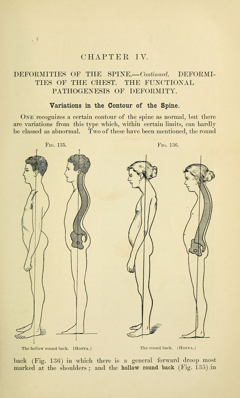 CHAPTER IV. DEFORMITIES OF THE S'Pl^Il.—Continued. DEFORMI- TIES OF THE CHEST. THE FUXCTIOXAL PATHOGEXESIS OF DEFORMITY. Variations in the Contour of the Spine. OxE recognizes a certain contour of the spine as normal, but there are variations from this type which, within certain hmits, can hardly be classed as abnormal. Two of these have been mentioned, the round Fig. 135. Fig. 1.36. The hollow round back. (Hoffa.) r/; The round back. (Hoffa.) back (Fig. 136) in which there is a general forward droop most marked at the shoulders ; and the hollow round back (Fig. 135) in