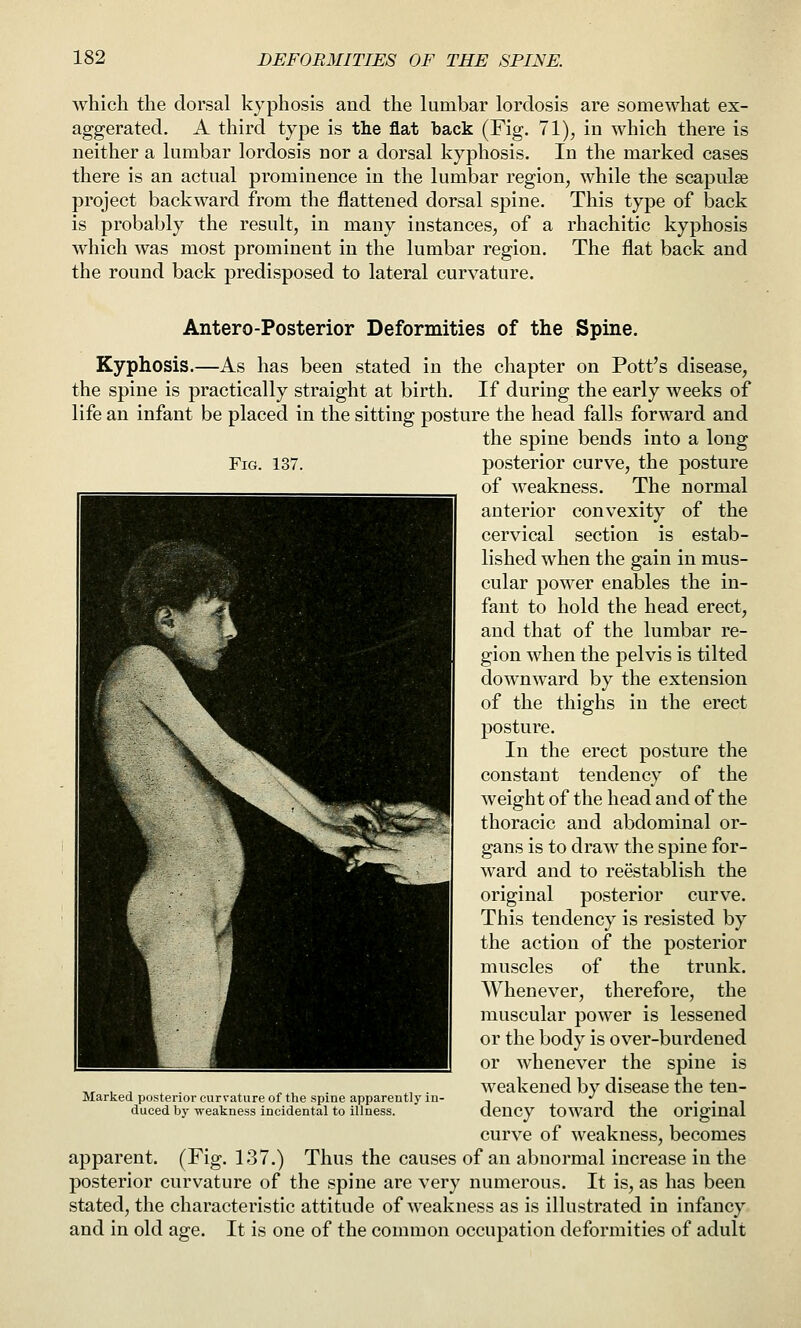 which the dorsal kyphosis and the lumbar lordosis are somewhat ex- aggerated. A third type is the flat back (Fig. 71), in which there is neither a lumbar lordosis nor a dorsal kyphosis. In the marked cases there is an actual prominence in the lumbar region, while the scapulae project backward from the flattened dorsal spine. This type of back is probably the result, in many instances, of a rhachitic kyphosis which was most prominent in the lumbar region. The flat back and the round back predisposed to lateral curvature. Antero-Posterior Deformities of the Spine. Kyphosis.—As has been stated in the chapter on Pott's disease, the spine is practically straight at birth. If during the early weeks of life an infant be placed in the sitting posture the head falls forward and the spine bends into a long Fig. 137. posterior curve, the posture of weakness. The normal anterior convexity of the cervical section is estab- lished when the gain in mus- cular power enables the in- fant to hold the head erect, and that of the lumbar re- gion when the pelvis is tilted downward by the extension of the thighs in the erect posture. In the erect posture the constant tendency of the weight of the head and of the thoracic and abdominal or- gans is to draw the spine for- ward and to reestablish the original posterior curve. This tendency is resisted by the action of the posterior muscles of the trunk. AVhenever, therefore, the muscular power is lessened or the body is over-burdened or whenever the spine is weakened by disease the ten- dency toward the original curve of weakness, becomes apparent. (Fig. 137.) Thus the causes of an abnormal increase in the posterior curvature of the spine are very numerous. It is, as has been stated, the characteristic attitude of weakness as is illustrated in infancy and in old age. It is one of the common occupation deformities of adult Marked posterior curvature of the spine apparently in- duced by weakness incidental to illness.