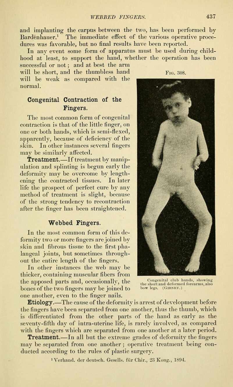 aud implanting the carpus between the two, has been performed by Bard^nhauer.^ The immediate effect of the various operative proce- dures was favorable, but no final results have been reported. In any event some form of apparatus must be used during child- hood at least, to support the hand, whether the operation has been successful or not; and at best the arm will be short, and the thumbless hand Fig. 308. will be weak as compared with the normal. Congenital Contraction of the Fingers. The most common form of congenital contraction is that of the little finger, on one or both hands, which is semi-flexed, apparently, because of deficiency of the skin. In other instances several fingers may be similarly affected. Treatment.—If treatment by manip- ulation and splinting is begun early the deformity may be overcome by length- ening the contracted tissues. In later life the prospect of perfect cure by any method of treatment is slight, because of the strong tendency to recontraction after the finger has been straightened. Webbed Fingers. In the most common form of this de- formity two or more fingers are joined by skin and fibrous tissue to the first pha- langeal joints, but sometimes through- out the entire length of the fingers. In other instances the web may be thicker, containing muscular fibers from the apposed parts and, occasionally, the ,,e feTzld det-med forl'arrsrirs! bones ol the two fingers may be joined to ^^^ '^gs. (Gibney.) one another, even to the finger nails. Etiology.—The cause of the deformity is arrest of development before the fingers have been separated from one another, thus the thumb, which is differentiated from the other parts of the hand as early as the seventy-fifth day of intra-uterine life, is rarely involved, as compared with the fingers which are separated from one another at a later period. Treatment.—In all but the extreme grades of deformity the fingers may be separated from one another; operative treatment being con- ducted according to the rules of plastic surgery. 1 Verhand. der deutsch. Gesells. fur Chir., 23 Kong., 1894.