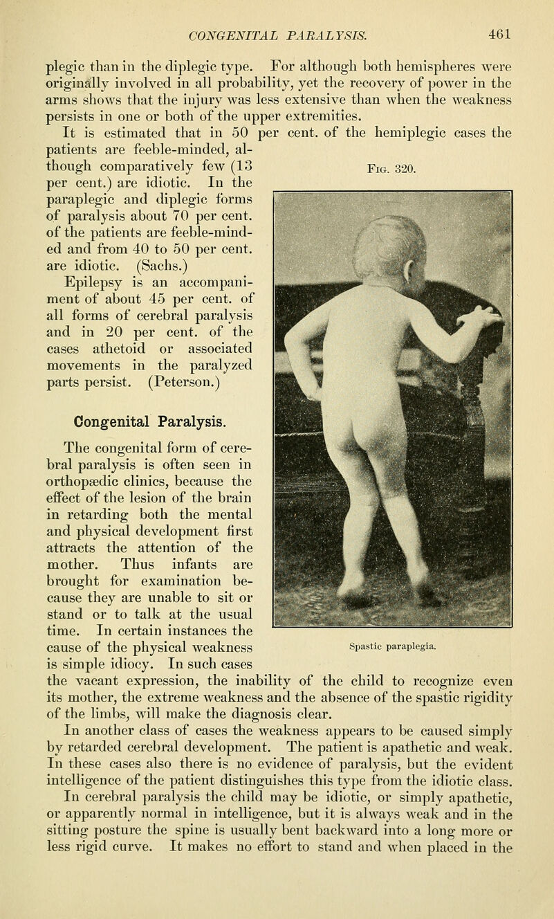 plegic than in the diplegic type. For although both hemispheres were originally involved in all probability, yet the recovery of power in the arms shows that the injury was less extensive than when the weakness persists in one or both of the upper extremities. It is estimated that in 50 per cent, of the hemiplegic cases the patients are feeble-minded, al- though comparatively few (13 Fig. 320. per cent.) are idiotic. In the paraplegic and diplegic forms of paralysis about 70 per cent, of the patients are feeble-mind- ed and from 40 to 50 per cent, are idiotic. (Sachs.) Epilepsy is an accompani- ment of about 45 per cent, of all forms of cerebral paralysis and in 20 per cent, of the cases athetoid or associated movements in the paralyzed parts persist. (Peterson.) Congenital Paralysis. The congenital form of cere- bral paralysis is often seen in orthopaedic clinics, because the effect of the lesion of the brain in retarding both the mental and physical development first attracts the attention of the mother. Thus infants are brought for examination be- cause they are unable to sit or stand or to talk at the usual time. In certain instances the cause of the physical weakness spastic paraplegia. is simple idiocy. In such cases the vacant expression, the inability of the child to recognize even its mother, the extreme weakness and the absence of the spastic rigidity of the limbs, will make the diagnosis clear. In another class of cases the weakness appears to be caused simply by retarded cerebral development. The patient is apathetic and weak. In these cases also there is no evidence of paralysis, but the evident intelligence of the patient distinguishes this type from the idiotic class. In cerebral paralysis the child may be idiotic, or simply apathetic, or apparently normal in intelligence, but it is always weak and in the sitting posture the spine is usually bent backward into a long more or less rigid curve. It makes no effort to stand and when placed in the