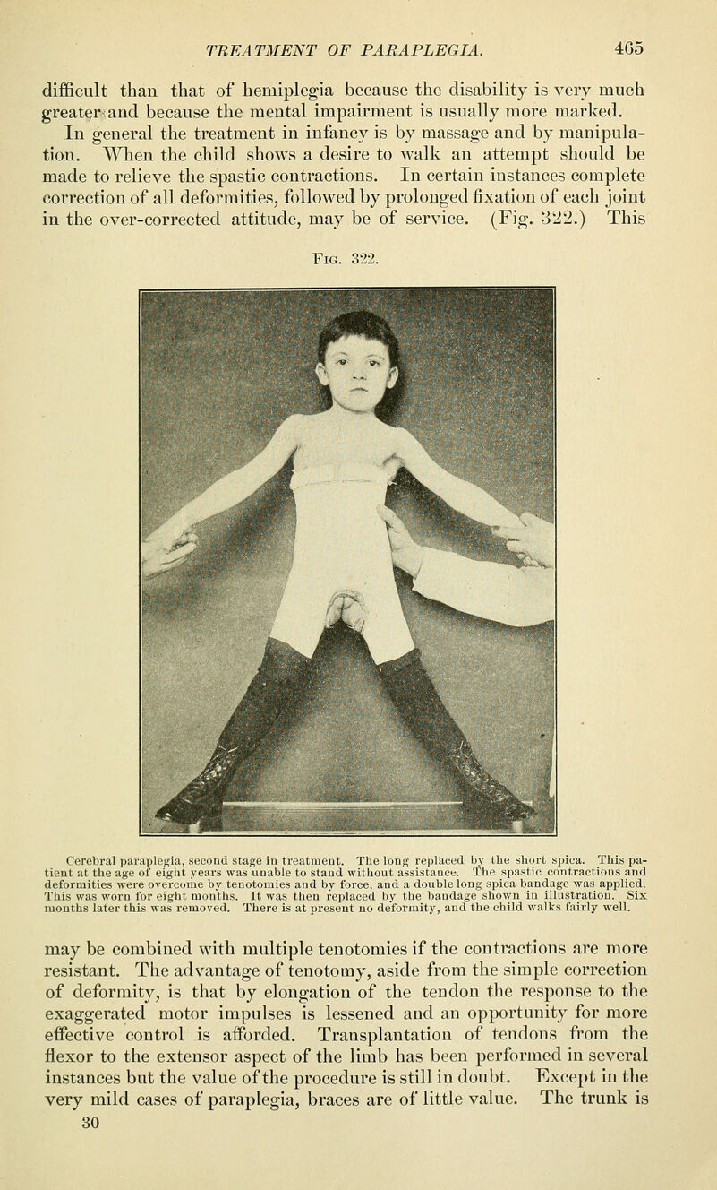 difficult than that of hemiplegia because the disability is very much greater-and because the mental impairment is usually more marked. In general the treatment in infancy is by massage and by manipula- tion. When the child shows a desire to walk an attempt should be made to relieve the spastic contractions. In certain instances complete correction of all deformities, followed by prolonged fixation of each joint in the over-corrected attitude, may be of service. (Fig. 322.) This Fig. 322. Cerebral paraplegia, second stage iu treatiueut. The long replaced by the short sisica. This pa- tient at the age of eight years was unable to stand without assistance. The spastic contractions and deformities were overcome by tenotomies and by force, and a double long spica bandage was applied. This was worn for eight months. It was then replaced by the bandage shown iu illustration. Six months later this was removed. There is at present no deformity, and the child walks fairly well. may be combined with multiple tenotomies if the contractions are more resistant. The advantage of tenotomy, aside from the simple correction of deformity, is that by elongation of the tendon the response to the exaggerated motor impulses is lessened and an opportunity for more effective control is afforded. Transplantation of tendons from the flexor to the extensor aspect of the limb has been performed in several instances but the value of the procedure is still in doubt. Except in the very mild cases of paraplegia, braces are of little value. The trunk is 30