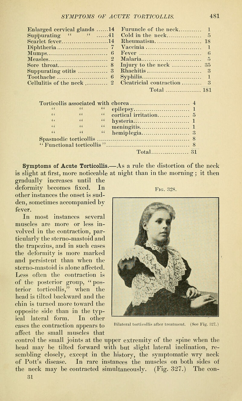 Enlarged cervical glands 14 Supfturating   41 Scarlet fever 14 Diphtheria 7 Mumps 6 Measles 2 Sore throat 8 Suppurating otitis 3 Toothache 6 Cellulitis of the neck 2 Furuncle of the neck 1 Cold in the neck 5 Rheumatism 18 Vaccinia 1 Fever 6 Malaria 5 Injury to the neck 35 Rhachitis 3 Syphilis 1 Cicatricial contiaction 3 Total T81 Torticollis associated with chorea 4    epilepsy 1 '*   cortical irritation 5 '' ^'  hysteria 1    meningitis 1 hemiplegia 3 Spasmodic torticollis ...  Functional torticollis Total 31 Fig. P)28. Symptoms of Acute Torticollis.—As a rule the distortion of the neck is slight at first, more noticeable at night than in the morning; it then gradually increases until the deformity becomes fixed. In other instances the onset is sud- den, sometimes accompanied by fever. In most instances several muscles are more or less in- volved in the contraction, par- ticularly the sterno-mastoid and the trapezius, and in such cases the deformity is more marked and persistent than when the sterno-mastoid is alone aiFected. Less often the contraction is of the posterior group,  pos- terior torticollis, when the head is tilted backward and the chin is turned more toward the opposite side than in the typ- ical lateral form. In other cases the contraction appears to affect the small muscles that control the small joints at the upper extremity of the spine when the head may be tilted forward with but slight lateral inclination, re- sembling closely, except in the history, the symptomatic wry neck of Pott's disease. In rare instances the muscles on both sides of Bilateral torticollis after treatment. (See Fig. the neck may be contracted simultaneously. 31 (Fig. 327.) The con-