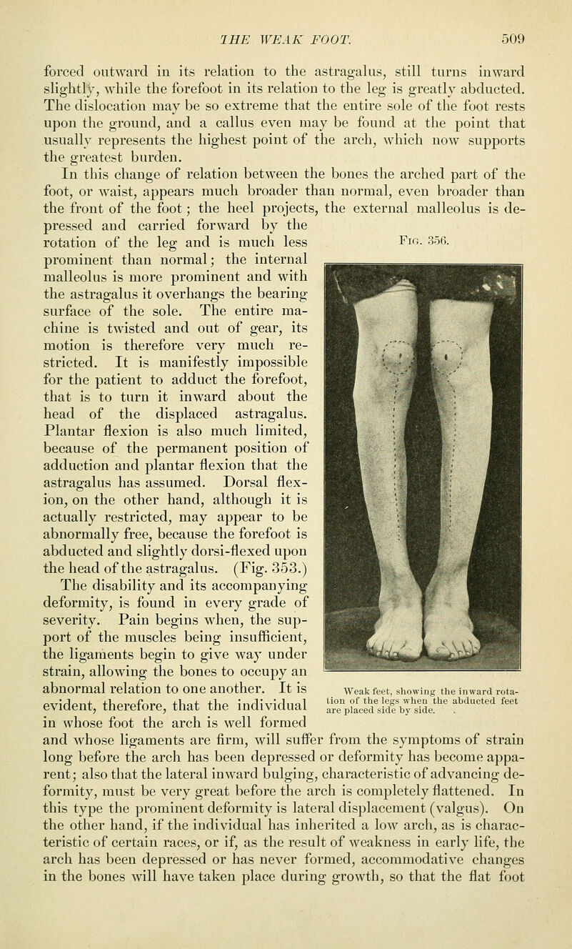 Fig. 356. forced outward in its relation to the astragalus, still turns inward slightly, while the forefoot in its relation to the leg is greatly abducted. The dislocation may be so extreme that the entire sole of the foot rests upon the ground, and a callus even may be found at the point that usually represents the highest point of the arch, which now supports the greatest burden. In this change of relation between the bones the arched part of the foot, or waist, appears much broader than normal, even broader than the front of the foot; the heel projects, the external malleolus is de- pressed and carried forward by the rotation of the leg and is much less prominent than normal; the internal malleolus is more prominent and with the astragalus it overhangs the bearing surface of the sole. The entire ma- chine is twisted and out of gear, its motion is therefore very much re- stricted. It is manifestly impossible for the patient to adduct the forefoot, that is to turn it inward about the head of the displaced astragalus. Plantar flexion is also much limited, because of the permanent position of adduction and plantar flexion that the astragalus has assumed. Dorsal flex- ion, on the other hand, although it is actually restricted, may appear to be abnormally free, because the forefoot is abducted and slightly dorsi-flexed upon the head of the astragalus. (Fig. 353.) The disability and its accompanying deformity, is found in every grade of severity. Pain begins when, the sup- port of the muscles being insufficient, the ligaments begin to give way under strain, allowing the bones to occupy an abnormal relation to one another. It is evident, therefore, that the individual in whose foot the arch is well formed and whose ligaments are firm, will suffer from the symptoms of strain long before the arch has been depressed or deformity has become appa- rent; also that the lateral inward bulging, characteristic of advancing de- formity, must be very great before the arch is completely flattened. In this type the prominent deformity is lateral displacement (valgus). On the other hand, if the individual has inherited a low arch, as is charac- teristic of certain races, or if, as the result of weakness in early life, the arch has been depressed or has never formed, accommodative changes in the bones will have taken place during growth, so that the flat foot Weak feet, showing the inward rota- tion of the legs when the abducted feet are placed side by side.