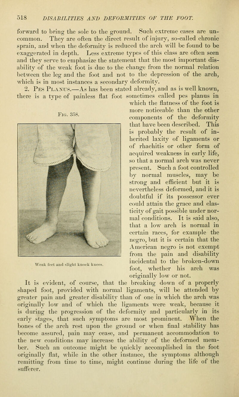 Fig. 358. forward to brins the sole to the ground. Such extreme cases are un- common. They are often the direct result of injury, so-called chronic sprain, and when the deformity is reduced the arch will be found to be exaggerated in depth. Less extreme types of this class are often seen and they serve to emphasize the statement that the most important dis- ability of the weak foot is due to the change from the normal relation between the leg and the foot and not to the depression of the arch, which is in most instances a secondary deformity. 2. Pes Planus.—As has been stated already, and as is well known, there is a type of painless flat foot sometimes called pes planus in which the flatness of the foot is more noticeable than the other components of the deformity that have been described. This is probably the result of in- herited laxity of ligaments or of rhachitis or other form of acquired weakness in early life, so that a normal arch was never present. Such a foot controlled by normal muscles, may be strong and efficient but it is nevertheless deformed, and it is doubtful if its pos.sessor ever could attain the grace and elas- ticity of gait possible under nor- mal conditions. It is said also, that a low arch is normal in certain races, for example the negro, but it is certain that the American negro is not exempt from the pain and disability incidental to the broken-down foot, whether his arch was originally low or not. It is evident, of course, that the breaking down of a properly shaped foot, provided with normal ligaments, will be attended by greater pain and greater disability than of one in which the arch was originally low and of which the ligaments were weak, because it is during the progression of the deformity and particularly in its early stages, that such symptoms are most prominent. When the bones of the arch rest upon the ground or when final stability has become assured, pain may cease, and permanent accommodation to the new conditions may increase the ability of the deformed mem- ber. Such an outcome might be quickly accomplished in the foot originally flat, while in the other instance, the symptoms although remitting from time to time, might continue during the life of the sufferer. Weak feet and slight knock knees.