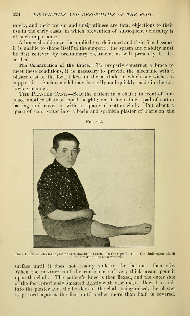 rately, and their weight and unsightliness are fatal objections to their use in the early cases, in which prevention of subsequent deformity is of such importance. A brace should never be applied to a deformed and rigid foot because it is unable to shape itself to the support; the spasm and rigidity must be first relieved by preliminary treatment, as will presently be de- scribed. The Construction of the Brace.—To properly construct a brace to meet these conditions, it is necessary to provide the mechanic with a plaster cast of the foot, taken in the attitude in which one wishes to support it. Such a model may be easily and quickly made in the fol- lowing manner. The Plaster Cast.—Seat the patient in a chair; in front of him place another chair of equal height; on it lay a thick pad of cotton batting and cover it with a square of cotton cloth. Put about a quart of cold Avater into a basin and sprinkle plaster of Paris on the Fig. 362. The attitude iu which the plaster cast should be taken. In the reproduction, the chair upon which the foot is resting, has been removed. surface until it does not readily sink to the bottom; then stir. When the mixture is of the consistence of very thick cream pour it upon the cloth. The patient's knee is then flexed, and the outer side of the foot, previously smeared lightly with vaseline, is allowed to sink into the plaster and, the borders of the cloth being raised, the plaster is pressed against the foot until rather more than half is covered.