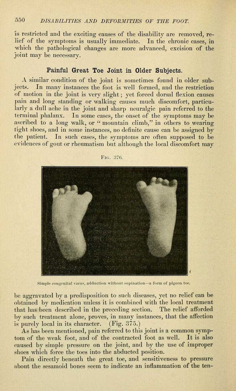 is restricted and the exciting causes of the disability are removed, re- lief of the symptoms is usually immediate. In the chronic cases, in which the pathological changes are more advanced, excision of the joint may be necessary. Painful Great Toe Joint in Older Subjects. A similar condition of the joint is sometimes found in older sub- jects. In many instances the foot is well formed, and the restriction of motion in the joint is very slight; yet forced dorsal flexion causes pain and long standing or walking causes much discomfort, particu- larly a dull ache in the joint and sharp neuralgic pain referred to the terminal phalanx. In some cases, the onset of the symptoms may be ascribed to a long walk, or  mountain climb, in others to wearing tight shoes, and in some instances, no definite cause can be assigned by the patient. In such cases, the symptoms are often supposed to be ■evidences of gout or rheumatism but although the local discomfort may Fig. 376. Simple congenital varus, adduction without supination—a form of pigeon toe. be aggravated by a predisposition to sucli diseases, yet no relief can be obtained by medication unless it is combined with the local treatment that has been described in the preceding section. The relief aiForded by such treatment alone, proves, in many instances, that the aifection is purely local in its character. (Fig. 375.) As has been mentioned, pain referred to this joint is a common symp- tom of the Aveak foot, and of the contracted foot as well. It is also caused by simple pressure on the joint, and by the use of improper shoes which force the toes into the abducted position. Pain directly beneath the great toe, and sensitiveness to pressure about the sesamoid bones seem to indicate an inflammation of the ten-