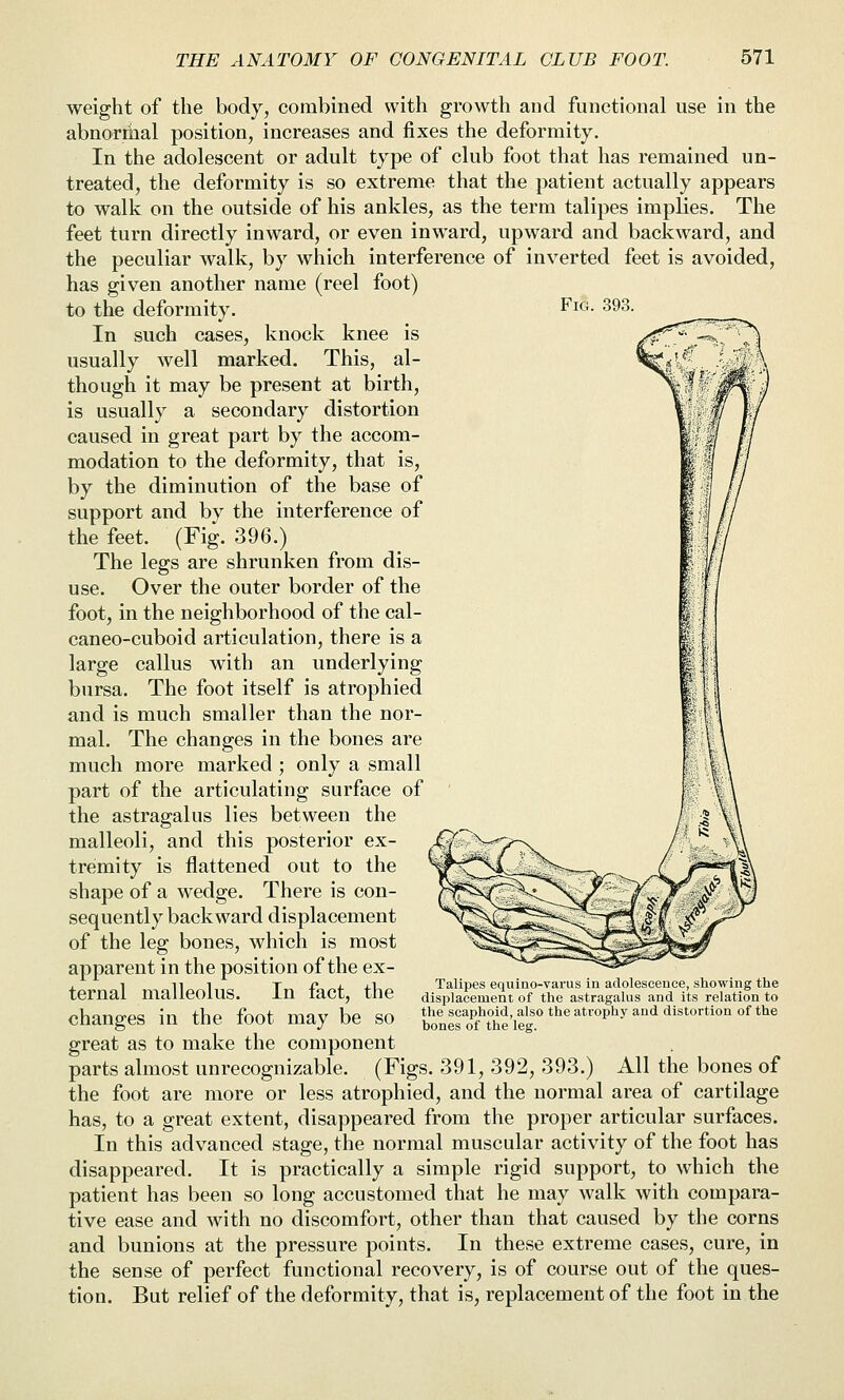 weight of the body, combined with growth and functional use in the abnorrhal position, increases and fixes the deformity. In the adolescent or adult type of club foot that has remained un- treated, the deformity is so extreme that the patient actually appears to walk on the outside of his ankles, as the term talipes implies. The feet turn directly inward, or even inward, upward and backward, and the peculiar walk, by which interference of inverted feet is avoided, has given another name (reel foot) to the deformity. In such cases, knock knee is usually well marked. This, al- though it may be present at birth, is usually a secondary distortion caused in great part by the accom- modation to the deformity, that is, by the diminution of the base of support and by the interference of the feet. (Fig. 396.) The legs are shrunken from dis- use. Over the outer border of the foot, in the neighborhood of the cal- caneo-cuboid articulation, there is a large callus with an underlying bursa. The foot itself is atrophied and is much smaller than the nor- mal. The changes in the bones are much more marked; only a small part of the articulating surface of the astragalus lies between the malleoli, and this posterior ex- tremity is flattened out to the shape of a wedge. There is con- sequently backward displacement of the leg bones, which is most apparent in the position of the ex- ternal malleolus. In fact, the changes in the foot may be so great as to make the component parts almost unrecognizable. (Figs. 391, 392, 393.) All the bones of the foot are more or less atrophied, and the normal area of cartilage has, to a great extent, disappeared from the proper articular surfaces. In this advanced stage, the normal muscular activity of the foot has disappeared. It is practically a simple rigid support, to which the patient has been so long accustomed that he may walk with compara- tive ease and with no discomfort, other than that caused by the corns and bunions at the pressure points. In these extreme cases, cure, in the sense of perfect functional recovery, is of course out of the ques- tion. But relief of the deformity, that is, replacement of the foot in the Talipes equino-varus in adolesceuce, showing the displacement of the astragalus and its relation to the scaphoid, also the atrophy and distortion of the bones of the leg.