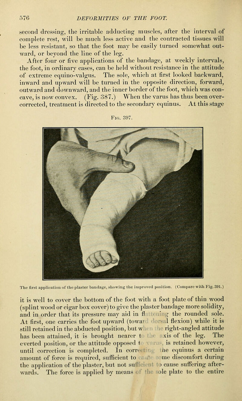 second dressing, the irritable adducting muscles, after the interval of complete rest, will be much less active and the contracted tissues will be less resistant, so that the foot may be easily turned somewhat out- ward, or beyond the line of the leg. After four or five applications of the bandage, at weekly intervals, the foot, in ordinary cases, can be held without resistance in the attitude of extreme equino-valgus. The sole, which at first looked backward, inward and upward will be turned in the opposite direction, forward, outward and downward, and the inner border of the foot, which was con- cave, is now convex. (Fig. 387.) When the varus has thus been over- corrected, treatment is directed to the secondary equinus. At this stage Fm. 397. The first application of the plaster baudage, showing the improved position. (Compare with Fig. 391.) it is well to cover the bottom of the foot with a foot plate of thin wood (splint wood or cigar box cover) to give the plaster bandage more solidity, and in order that its pressure may aid in fl itenlng the rounded sole. At first, one carries the foot upward (towai ' flot>:il flexion) while it is still retained in the abducted position, but wIk h 'ic right-angled attitude has been attained, it is brought nearer tf> the axis of the leg. The everted position, or the attitude opposed to vnru'^. is retained however, until correction is completed. In correcting ihe equinus a certain amount offeree is required, sufficient to crur>c .^tme discomfort during the application of the plaster, but not sufficient to cause suffering after- wards. The force is applied by means of the sole plate to the entire