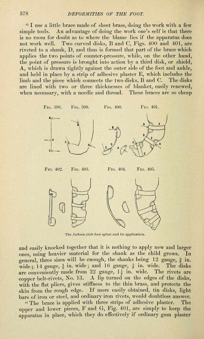  I use a little brace made of sheet brass, doing the work with a few simple tools. An advantage of doing the work one's self is that there is no room for doubt as to where the blame lies if the apparatus does not work well. Two curved disks, B and C, Figs. 400 and 401, are riveted to a shank, D, and thus is formed that part of the brace which applies the two points of counter-pressure, while, on the other hand, the point of pressure is brought into action by a third disk, or shield, A, which is drawn tightly against the outer side of the foot and ankle, and held in place by a strip of adhesive plaster E, which includes the limb and the piece which connects the two disks, B and C. The disks are lined with two or three thicknesses of blanket, easily renewed, when necessary, with a needle and thread. These braces are so cheap Fig. 398. Fig. 399 Fig. 400. Fig. 401. Fig. 402. Fig. 403. Fig. 404. Fig. 405. The Judson club foot splint and its application. and easily knocked together that it is nothing to apply new and larger ones, using heavier material for the shank as the child grows. In general, three sizes will be enough, the shanks being 12 gauge, | in. wide; 14 gauge, | in. wide; and 16 gauge, f in. wide. The disks are conveniently made from 22 gauge, 1\ in. wide. The rivets are copper belt-rivets. No. 13. A lip turned on the edges of the disks, with the flat pliers, gives stiffness to the thin brass, and protects the skin from the rough edge. If more easily obtained, tin disks, light bars of iron or steel, and ordinary iron rivets, would doubtless answer.  The brace is applied with three strips of adhesive plaster. The upper and lower pieces, F and G, Fig. 401, are simply to keep the apparatus in place, which they do effectively if ordinary gum plaster