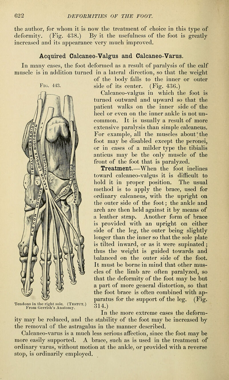 Fig. 443. the author, for whom it is now the treatment of choice in this type of deformity. (Fig. 438.) By it the usefulness of the foot is greatly increased and its appearance very much improved. Acquired Calcaneo-Valgus and Calcaneo-Varus. In many cases, the foot deformed as a result of paralysis of the calf muscle is in addition turned in a lateral direction, so that the weight of the body falls to the inner or outer side of its center. (Fig. 436.) Calcaneo-valgus in which the foot is turned outward and upward so that the patient walks on the inner side of the heel or even on the inner ankle is not un- common. It is usually a result of more extensive paralysis than simple calcaneus. For example, all the muscles about the foot may be disabled except the peronei, or in cases of a milder type the tibialis anticus may be the only muscle of the front of the foot that is paralyzed. Treatment.—When the foot inclines toward calcaneo-valgus it is difficult to hold it in proper position. The usual method is to apply the brace, used for ordinary calcaneus, with the upright on the outer side of the foot; the ankle and arch are then held against it by means of a leather strap. Another form of brace is provided with an upright on either side of the leg, the outer being slightly longer than the inner so that the sole plate is tilted inward, or as it were supinated; thus the weight is guided towards and balanced on the outer side of the foot. It must be borne in mind that other mus- cles of the limb are often paralyzed, so that the deformity of the foot may be but a part of more general distortion, so that the foot brace is often combined with ap- paratus for the support of the leg. (Fig. 314.) In the more extreme cases the deform- ity may be reduced, and the stability of the foot may be increased by the removal of the astragalus in the manner described. Calcaneo-varus is a much less serious affection, since the foot may be more easily supported. A brace, such as is used in the treatment of ordinary varus, without motion at the ankle, or provided with a reverse stop, is ordinarily employed. Tendons in the right sole, From Gerrish's Anatomy (Testut. )