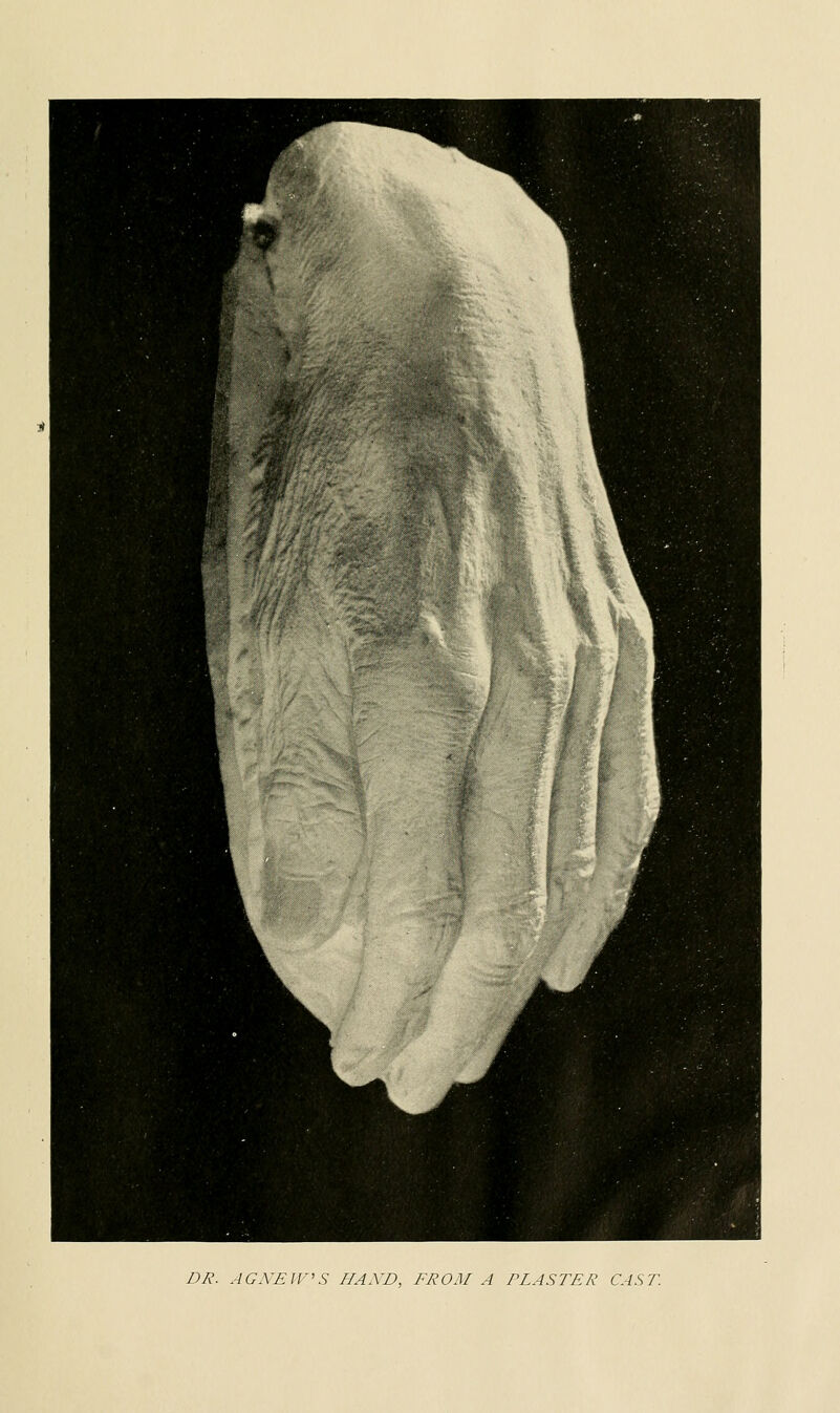 DR. AG NEWS IIAXD, FROM A PLASTER CAST.