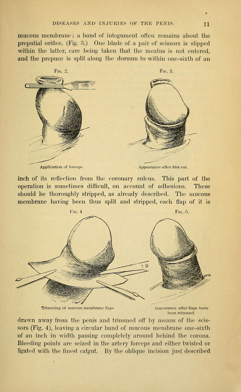 mucous membrane ; a band of integument often remains about the preputial orifice. (Fig. 3.) One blade of a pair of scissors is slipped within the latter, care being taken that the meatus is not entered, and the prepuce is split along the dorsum to within one-sixth of an Fig. 3. Application of forceps. Appearance after first cut. inch of its reflection from the coronary sulcus. This part of the operation is sometimes difficult, on account of adhesions. These should be thoroughly stripped, as already described. The mucous membrane having been thus split and stripped, each flap of it is Fig. 4 Fk;. 5. Trimming of mucous membrane flaps. Appearance after flaps have been trimmed. drawn away from the penis and trimmed off by means of the scis- sors (Fig. 4), leaving a circular band of mucous membrane one-sixth of an inch in width passing completely around behind the corona. Bleeding points are seized in the artery forceps and either twisted or ligated with the finest catgut. By the oblique incision just described