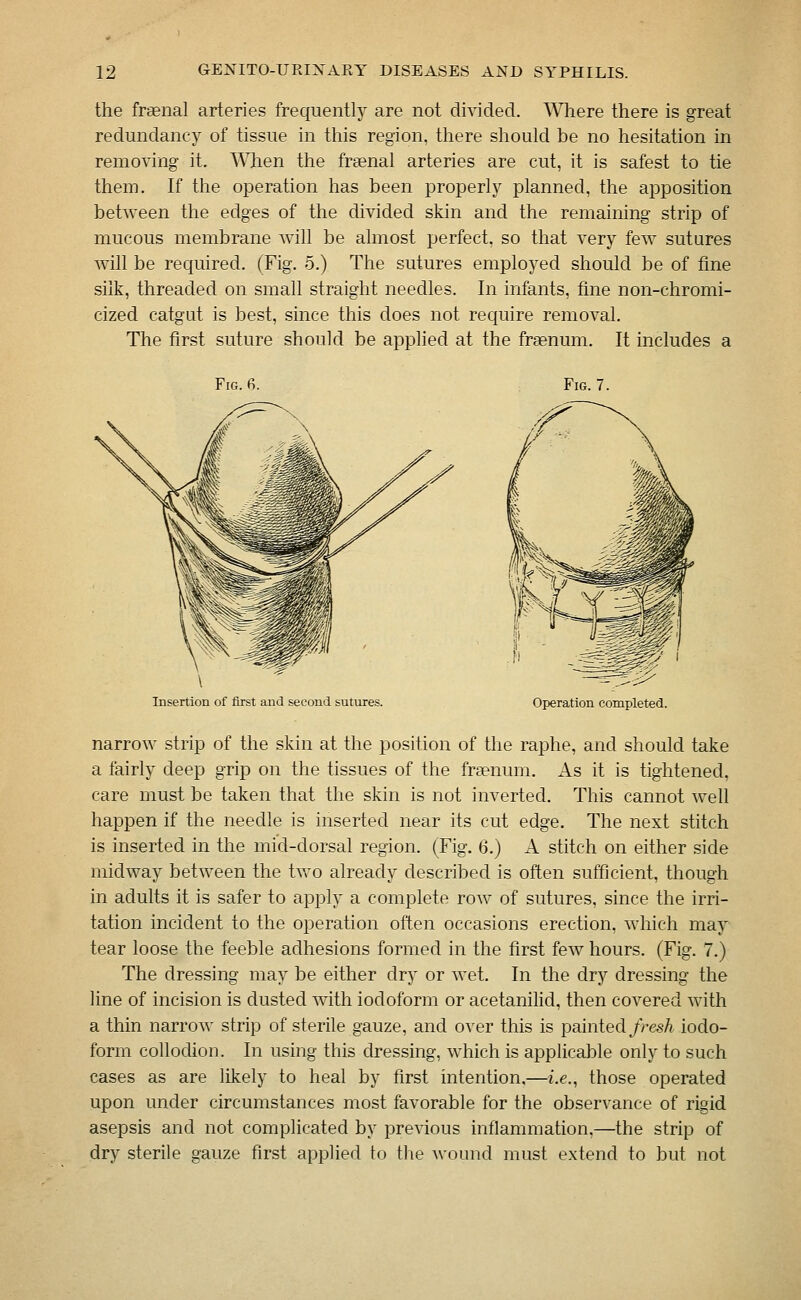 the fraenal arteries frequently are not divided. Where there is great redundancy of tissue in this region, there sliould be no hesitation in removing it. When the frsenal arteries are cut, it is safest to tie them. If the operation has been properly planned, the apposition between the edges of the divided skin and the remaining strip of mucous membrane will be almost perfect, so that very few sutures will be required. (Fig. 5.) The sutures employed should be of fine silk, threaded on small straight needles. In infants, fine non-chromi- cized catgut is best, since this does not require removal. The first suture should be applied at the fraenum. It includes a Fig. 6. Fig. 7. Insertion of first and second sutures. Operation completed. narrow strip of the skin at the position of the raphe, and should take a fairly deep grip on the tissues of the frgenum. As it is tightened, care must be taken that the skin is not inverted. This cannot well happen if the needle is inserted near its cut edge. The next stitch is inserted in the mid-dorsal region. (Fig. 6.) A stitch on either side midway between the two already described is often sufficient, though in adults it is safer to apply a complete row of sutures, since the irri- tation incident to the operation often occasions erection, which may tear loose the feeble adhesions formed in the first few hours. (Fig. 7.) The dressing may be either dry or wet. In the dry dressing the line of incision is dusted with iodoform or acetanilid, then covered with a thin narrow strip of sterile gauze, and o^-er this is painted/rcs/i iodo- form collodion. In using this dressing, which is applicable only to such cases as are likely to heal by first intention,—i.e., those operated upon under circumstances most favorable for the observance of rigid asepsis and not complicated by pre^dous inflammation,—the strip of dry sterile gauze first applied to the wound must extend to but not