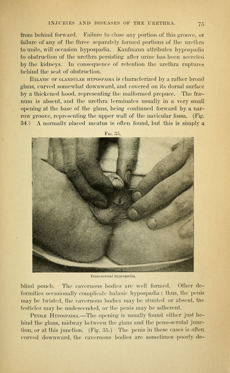 from behind forward. Failure to close any portion of this groove, or failure of any of the three separately formed portions of the urethra to unite, will occasion hypospadia. Kaufmann attributes hypospadia to obstruction of the urethra persisting after urine has been secreted by the kidneys. In consequence of retention the urethra ruptures behind the seat of obstruction. Balanic or GLANDULAR HYPOSPADIA is characterized by a rather broad glans, curved somewhat downward, and covered on its dorsal surface by a thickened hood, representing the malformed prepuce. The frse- num is absent, and the urethra terminates usually in a very small opening at the base of the glans, being continued forward by a nar- row groove, representing the upper wall of the navicular fossa. (Fig. 34.) A normally placed meatus is often found, but this is simply a Fig. 35. Peno-scrotal hypospadia. bhnd pouch. The cavernous bodies are well formed. Other de- formities occasionally complicate balanic hypospadia; thus, the penis may be twisted, the cavernous bodies may be stunted or absent, the testicles may be undescended, or the penis may be adherent. Penile Hypospadia.—The opening is usually found either just be- hind the glans, midway between the glans and the peno-scrotal junc- tion, or at this junction. (Fig. 35.) The penis in these cases is often curved downward, the cavernous bodies are sometimes poorly de-