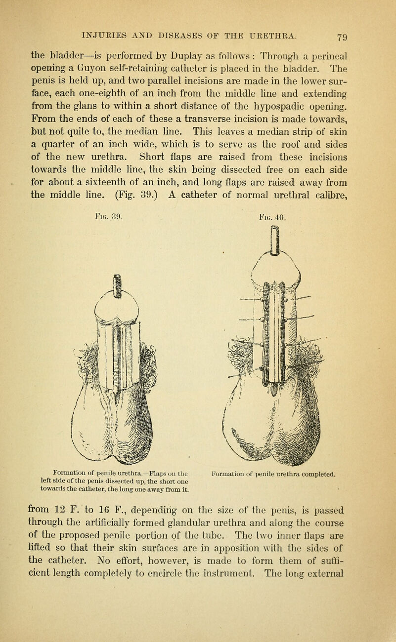 the bladder—is performed by Duplay as follows : Through a perineal opening a Guyon self-retaining catheter is placed in the bladder. The penis is held up, and two parallel incisions are made in the lower sur- face, each one-eighth of an inch from the middle line and extending from the glans to within a short distance of the hypospadic opening. From the ends of each of these a transverse incision is made towards, but not quite to, the median line. This leaves a median strip of skin a quarter of an inch wide, which is to serve as the roof and sides of the new urethra. Short flaps are raised from these incisions towards the middle line, the skin being dissected free on each side for about a sixteenth of an inch, and long flaps are raised away from the middle line. (Fig. 39.) A catheter of normal urethral calibre, Fig. 39. Fig. 40. Formation of penile urethra.—Flaps on the left side of the penis dissected up, the short one towards the catheter, the long one away from it. Formation of penile urethra completed. from 12 F. to 16 F., depending on the size of the penis, is passed through the artificially formed glandular urethra and along the course of the proposed penile portion of the tube. The two inner flaps are lifted so that their skin surfaces are in apposition with the sides of the catheter. No effort, however, is made to form them of suffi- cient length completely to encircle the instrument. The long external