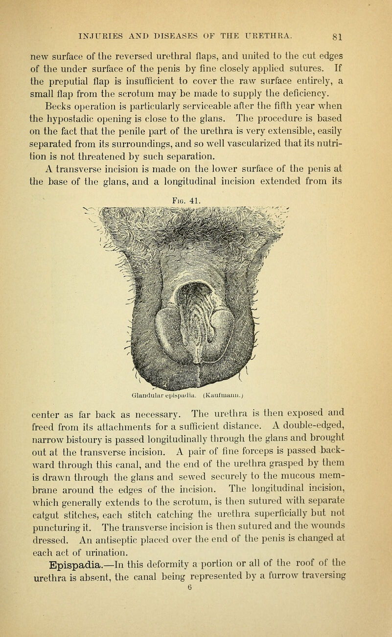 new surface of the reversed urethral flaps, and united to the cut edges of the under surface of the penis by fine closely applied sutures. If the preputial flap is insufficient to cover the raw surface entirely, a small flap from the scrotum may be made to supply the deficiency. Becks operation is particularly serviceable after the fifth year when the hypostadic opening is close to the glans. The procedure is based on the fact that the penile part of the urethra is very extensible, easily separated from its surroundings, and so well vascularized that its nutri- tion is not threatened by such separation, A transverse incision is made on the lower surface of the penis at the base of the glans, and a longitudinal incision extended from its Fig 41 ■f- mimmmjupiii Glandular epispadia. (Kaufmaiui.) center as far back as necessary. The urethra is then exposed and freed from its attachments for a sufficient distance. A double-edged, narrow bistoury is passed longitudinally through the glans and brought out at the transverse incision. A pair of fine forceps is passed back- ward through this canal, and the end of the urethra grasped by them is drawn through the glans and sewed securely to the mucous mem- brane around the edges of the incision. The longitudinal incision, which generally extends to the scrotum, is then sutured with separate catgut stitches, each stitch catching the urethra superficially but not puncturing it. The transverse incision is then sutured and the wounds dressed. An antiseptic placed over the end of the penis is changed at each act of urination. Epispadia.—In this deformity a portion or all of the roof of the urethra is absent, the canal being represented by a furrow traversing 6