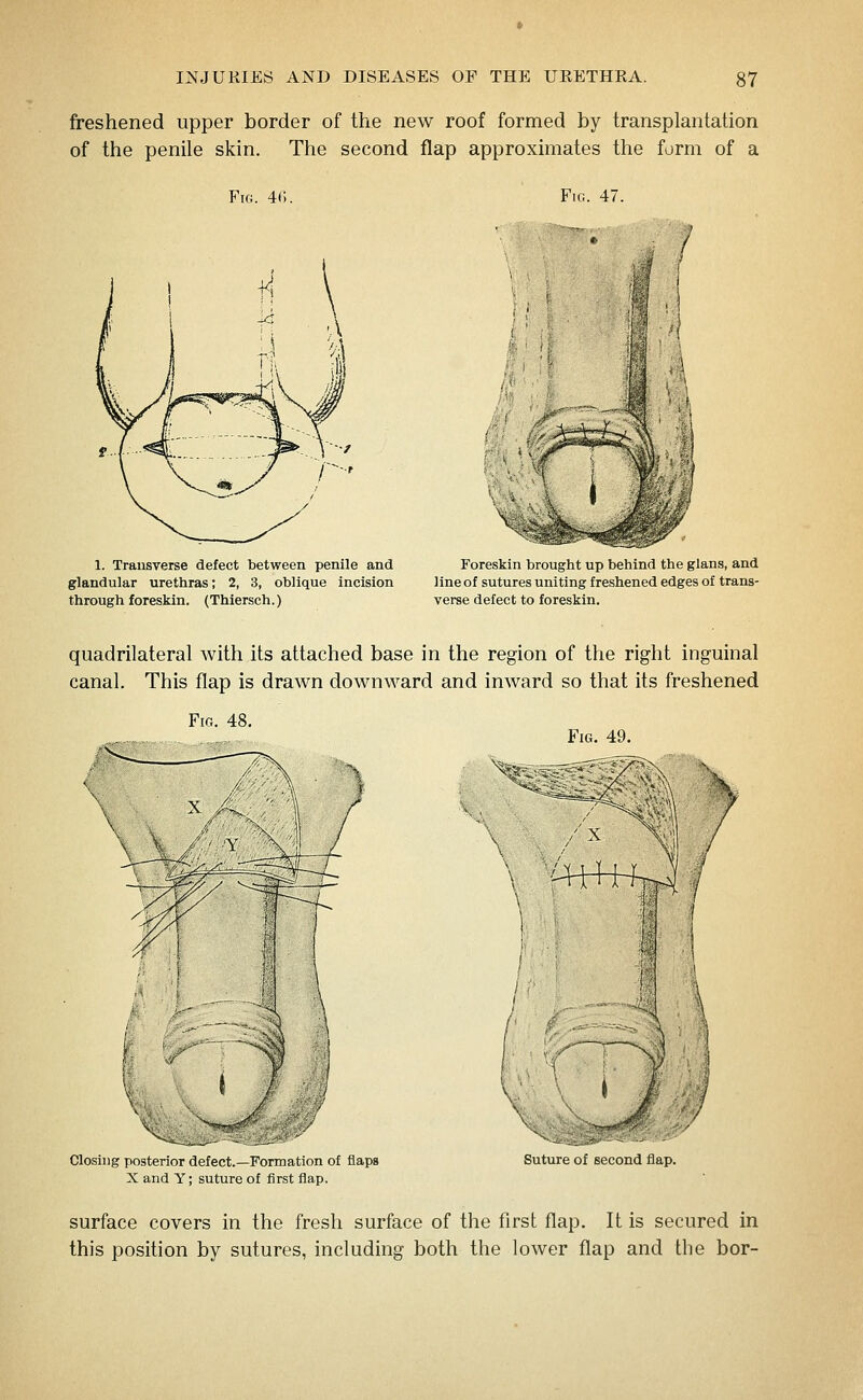 freshened upper border of the new roof formed by transplantation of the penile skin. The second flap approximates the form of a Fig. 40. Fig. 47. 1. Transverse defect between penile and Foreskin brought up behind the glans, and glandular urethras; 2, 3, oblique incision lineof sutures uniting freshened edges of trans- through foreskin. (Thiersch.) verse defect to foreskin. quadrilateral with its attached base in the region of the right inguinal canal. This flap is drawn downward and inward so that its freshened Fig. 48. Closing posterior defect.—Formation of flaps X and Y; suture of first flap. Fig. 49. Suture of second flap. surface covers in the fresh surface of the first flap. It is secured in this position by sutures, including both the lower flap and the bor-
