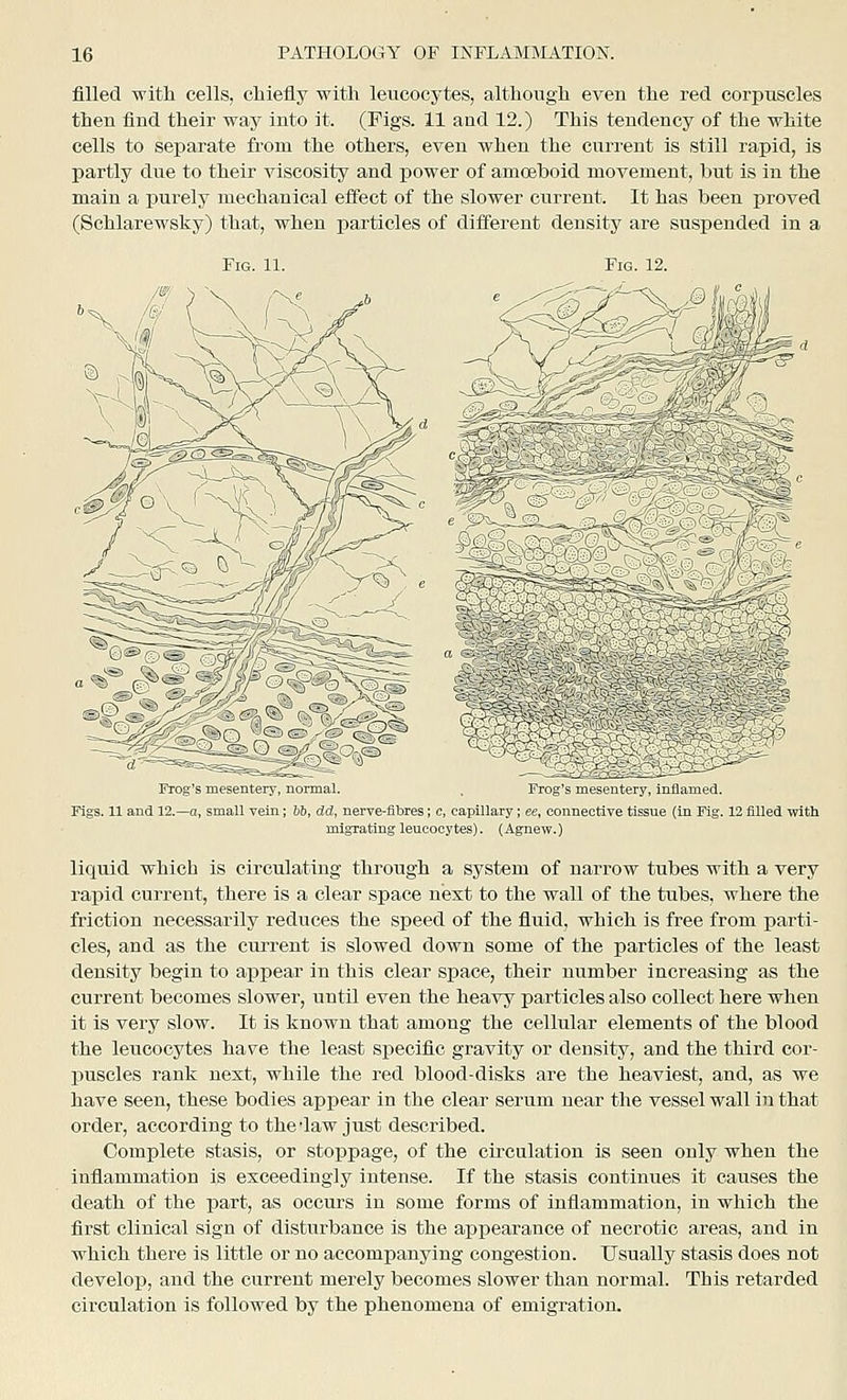 filled witli cells, chiefly with leucocytes, although even the red corpuscles then find their way into it. (Figs. 11 and 12.) This tendency of the white cells to separate from the others, even when the current is still rapid, is partly due to their viscosity and j)ower of amoeboid movement, but is in the main a purely mechanical effect of the slower current. It has been proved (Schlarewsky) that, when particles of different density are suspended in a Fig. 11. Fig 12. Frog's mesentery, normal. FrOo iiit l lUn mil Figs. 11 and 12.—o, small vein; bb, dd, nerve-flbres; c, capillary, ee, connective ti'sue (m Fig 12 filled with migrating leucocytes). (Agnew.) liquid which is circulating through a system of narrow tubes with a very rapid current, there is a clear space next to the wall of the tubes, where the friction necessarily reduces the speed of the fluid, which is free from parti- cles, and as the current is slowed down some of the particles of the least density begin to appear in this clear space, their number increasing as the current becomes slower, until even the heavy particles also collect here when it is very slow. It is known that among the cellular elements of the blood the leucocytes have the least specific gravity or density, and the third cor- puscles rank next, while the red blood-disks are the heaviest, and, as we have seen, these bodies appear in the clear serum near the vessel wall in that order, according to the daw just described. Complete stasis, or stoppage, of the circulation is seen only when the inflammation is exceedingly intense. If the stasis continues it causes the death of the part, as occurs in some forms of inflammation, in which the flrst clinical sign of disturbance is the appearance of necrotic areas, and in which there is little or no accompanying congestion. Usually stasis does not develop, and the current merely becomes slower than normal. This retarded circulation is followed by the phenomena of emigration.