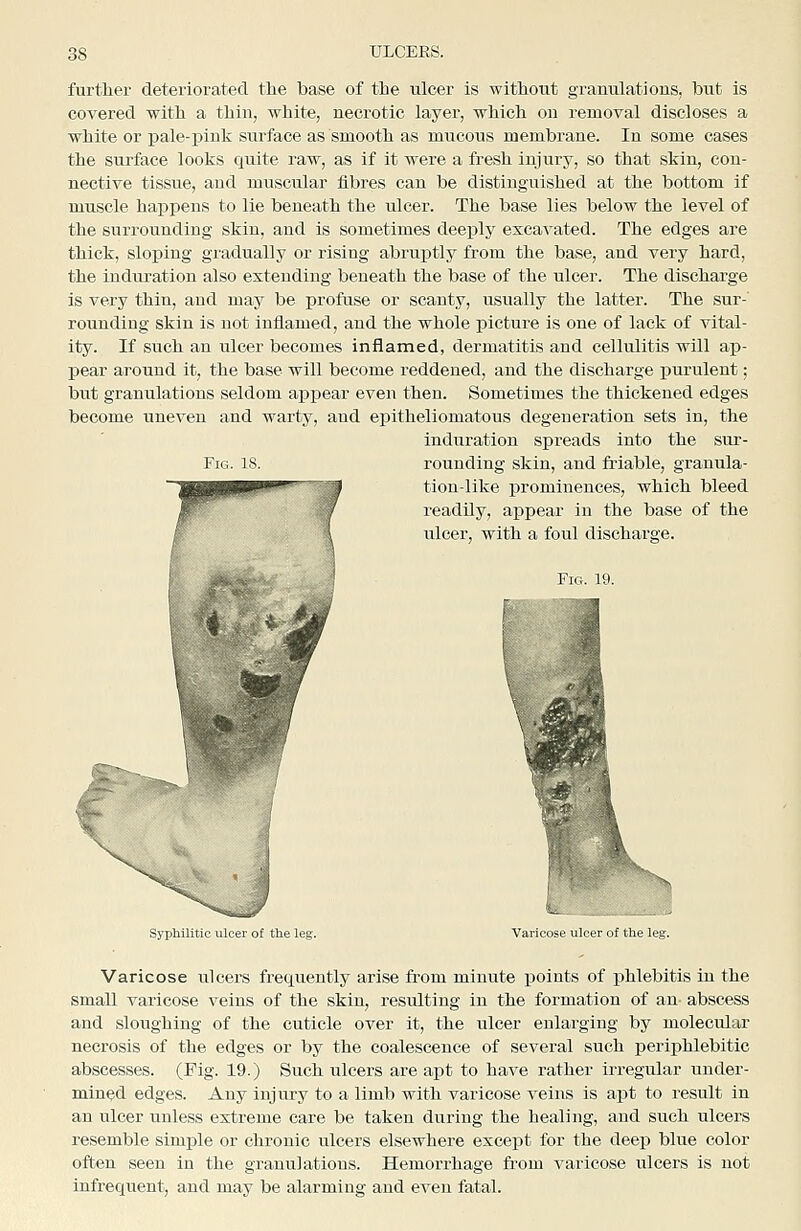 further deteriorated tlie base of the nicer is without granulations, but is covered with a thin, white, necrotic layer, which on removal discloses a white or pale-pink surface as smooth as mucous membrane. In some cases the surface looks quite raw, as if it were a fresh injury, so that skin, con- nective tissue, and muscular fibres can be distinguished at the bottom if muscle happens to lie beneath the ulcer. The base lies below the level of the surroundiug skin, and is sometimes deeply excavated. The edges are thick, sloping gradually or rising abruptly from the base, and very hard, the induration also extending beneath the base of the ulcer. The discharge is very thin, and may be profuse or scanty, usually the latter. The sur- rounding skin is not inflamed, and the whole picture is one of lack of vital- ity. If such an ulcer becomes inflamed, dermatitis and cellulitis will ap- pear around it, the base will become reddened, and the discharge purulent; but granulations seldom appear even then. Sometimes the thickened edges become uneven and warty, and epitheliomatous degeueration sets in, the induration spreads into the sur- FiG. 18. rounding skin, and friable, granula- tion-like prominences, which bleed readily, appear in the base of the ulcer, with a foul discharge. Fig. 19. Syphilitic ulcer of the leg. Varicose ulcer of the 1 Varicose ulcers frequently arise from minute points of phlebitis in the small varicose veins of the skin, resulting in the formation of an abscess and sloughing of the cuticle over it, the ulcer enlarging by molecular necrosis of the edges or by the coalescence of several such periphlebitic abscesses. (Fig. 19.) Such ulcers are apt to have rather irregular under- mined edges. Any injury to a limb with varicose veins is apt to result in an ulcer unless extreme care be taken during the healing, and such ulcers resemble simple or chronic ulcers elsewhere except for the deep blue color often seen in the granulations. Hemorrhage fiom varicose ulcers is not infrequent, and may be alarming and even fatal.