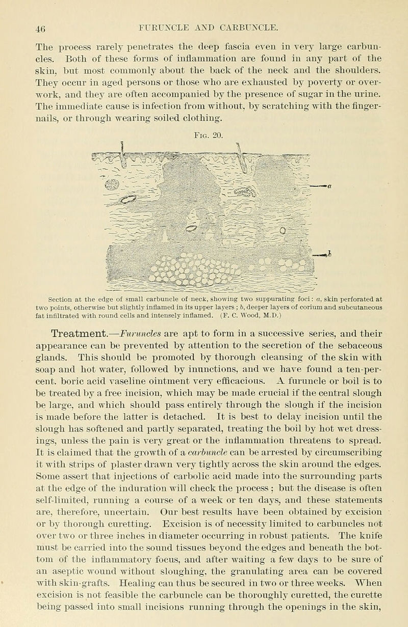 The ijrocess rarely penetrates the deep fascia even in very large carbun- cles. Both of these forms of inflammation are found in any part of the skin, but most commonly about the back of the neck and the shoulders. They occur in aged persons or those who are exhausted by poverty or over- work, and they are often accompanied by the presence of sugar in the urine. The immediate cause is infection from without, by scratching with the finger- nails, or through wearing soiled clothing. Section at the edge of small caibuncle of neck, hliu\\iug two suppurating foci: a, skin perforated at two points, otherwise but slighth inflamed m its upper layers , b, deeper layers of corimn and subcutaneous fat infiltrated with round cells and intensely inflamed. (F. C. AVood, M.D.) Treatment.—Furuncles are apt to form in a successive series, and their appearance can be prevented by attention to the secretion of the sebaceous glands. This should be promoted by thorough cleansing of the skin with soap and hot water, followed by inunctions, and we have found a ten-per- cent, boric acid vaseline ointment very efficacious. A furuncle or boil is to be treated by a free incision, which may be made crucial if the central slough be large, and which should pass entii-ely through the slough if the incision is made before the latter is detached. It is best to delay incision until the slough has softened and partly separated, treating the boil by hot wet dress- ings, unless the pain is very great or the inflammation threatens to spread. It is claimed that the growth of a carbuncle can be arrested by circumscribing it with strips of plaster di-awn very tightly across the skin around the edges. Some assert that injections of carbolic acid made into the sm-rouuding parts at the edge of the induration will check the process ; but the disease is often self-limited, running a course of a week or ten days, and these statements are, therefore, uncertain. Our best results have been obtained by excision or by thorough curetting. Excision is of necessity limited to carbuncles not over two or three inches in diameter occurring in robust patients. The knife must be carried into the sound tissues beyond the edges and beneath the bot- tom of the inflammatory focus, and after waiting a few days to be sure of an aseptic wound without sloughing, the granulating area can be covered with skin-grafts. Healing can thus be secured in two or three weeks. When excision is not feasible the carbuncle can be thoroughly curetted, the curette being passed into small incisions running through the openings in the skin.
