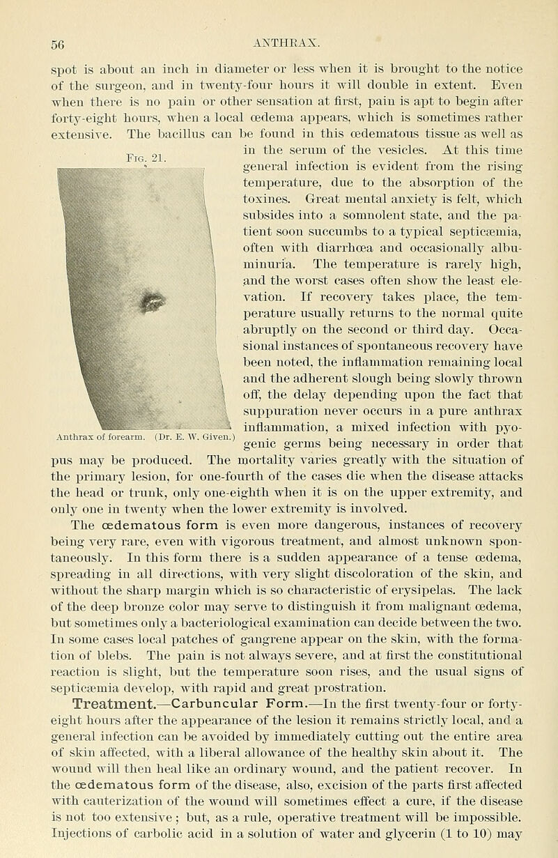 Fig. 21. Anthrax of forearm. (Dr. E. W. Given.) spot is about an inch in diameter or less when it is bronglit to the notice of the surgeon, and in twenty-four hours it will double in extent. Even when there is no pain or other sensation at first, pain is apt to begin after forty-eight hovirs, when a local oedema appears, which is sometimes rather extensive. The bacillus can be found in this cedematous tissue as well as in the serum of the vesicles. At this time general infection is evident from the rising temperature, due to the absorption of the toxines. Great mental anxiety is felt, which subsides into a somnolent state, and the pa- tient soon succumbs to a tyiiical septicaemia, often with diarrhoea and occasionally albu- minuria. The temperature is rarely high, and the worst cases often show the least ele- vation. If recovery takes place, the tem- iserature usually returns to the normal ciuite abruptly on the second or third day. Occa- sional instances of spontaneous recovery have been noted, the inflammation remaining local and the adherent slough being slowly thrown off, the delay dejjending upon the fact that sui^puration never occurs in a pure anthrax inflammation, a mixed infection with pj^o- genic germs being necessary in order that pus may be produced. The mortality varies greatly with the situation of the primary lesion, for one-fourth of the cases die when the disease attacks the head or trunk, only one-eighth when it is on the uj)per extremity, and only one in twenty when the lower extremity is involved. The cedematous form is even more dangerous, instances of recovery being very rare, even with vigorous treatment, and almost unknown spon- taneously. In this form there is a sudden appearance of a tense oedema, spreading in all directions, with very slight discoloration of the skin, and without the sharj) margin which is so characteristic of erysiijelas. The lack of the deep bronze color may serve to distinguish it from malignant oedema, but sometimes only a bacteriological examination can decide between the two. In some cases local patches of gangrene appear on the skin, with the forma- tion of blebs. The pain is not always severe, and at first the constitutional reaction is slight, but the temperature soon rises, and the usual signs of septici3emia develop, with rapid and great prostratiou. Treatment.—Carbuncular Form.—In the first twenty-four or forty- eight hours after the api>earance of the lesion it remains strictly local, and a general infection can he avoided by immediately cutting out the entire area of skin affected, with a liberal allowance of the healthy skin about it. The wound will then heal like an ordinary wound, and the patient recover. In the cedematous form of the disease, also, excision of the parts first affected with cauterization of the wound will sometimes effect a cure, if the disease is not too extensive ; but, as a rule, operative treatment will be impossible.