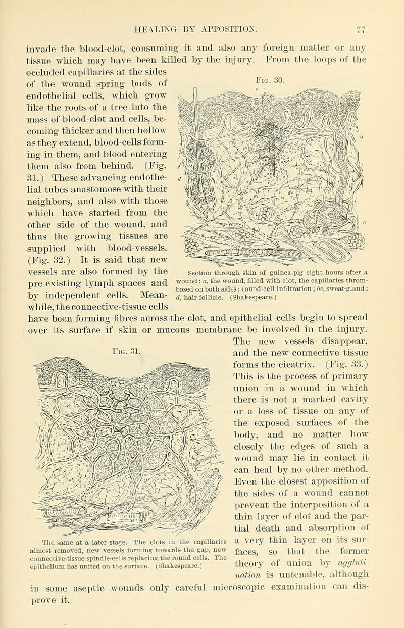 HEALING BY APPOSITION. Fig. 30. l\ S 'M ^5■y^ i' A :?A =•-^6*7° /- -») Section through skin of guinea pig eight hours after a wound: a, the wound, filled with clot, the capillaries throm- bosed onhoth sides; round-cell infiltration; be, sweat-gland; d, hair-follicle. invade tlie blood-clot, consuming it and also any foreign matter or any tissue which may have been killed by the injury. Prom the loops of the occluded capillaries at the sides of the wound spring buds of endothelial cells, which grow like the roots of a tree iuto the mass of blood-clot and cells, be- coming thicker and then hollow as they extend, blood-cells form- ing in them, and blood entering them also from behind. (Fig. 31.) These advancing endothe- lial tubes anastomose with their neighbors, and also with those which have started from the other side of the wound, and thus the growing tissues are supplied with blood-vessels. (Fig. 32.) It is said that new vessels are also formed by the pre-existing lymph spaces and by independent cells. Mean- while, the connective-tissue cells have been forming fibres across the clot, and epithelial cells begin to spread over its surface if skin or mucous membrane be involved in the injury. The new vessels disappear, and the new connective tissue forms the cicatrix. (Fig. 33.) This is the process of primary union in a wound in which there is not a marked cavity or a loss of tissue on any of the exposed surfaces of the body, and no matter how closely the edges of such a wound may lie in contact it can heal by no other method. Even the closest apposition of the sides of a wound cannot prevent the interi^osition of a thin layer of clot and the par- ~ ^, - — -^ ~' tial death and absorption of The same at a later stage. The clots m the capillaries a Very thin layer OU itS SUT- almost removed, new vessels forming towards the gap, new faceS SO that the former connective-tissue spindle-cells replacing the round cells. The ,, ' j. . ■. 7 ^ ■ epithelium has united on the surface. (Shakespeare.) theory Ot UUlOn by aggluti- nation is untenable, although in some aseptic wounds only careful microscopic examination can dis- prove it. Fig 31 -% t m^ ^' ?m