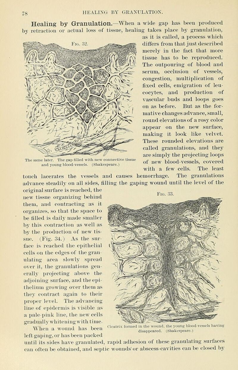 HEAXING BY GRANULATION. The same later. The gap flUed with new connective tissue and young blood-vessels. Healing by Granulation.—When a wide gap has been produced by retraction or actual loss of tissue, healing takes place by granulation, as it is called, a process which differs from that just described merely in the fact that more tissue has to be reproduced. The outpouring of blood and serum, occlusion of vessels, congestion, multij)lication of fixed cells, emigration of leu- cocytes, and production of vascular buds and loops goes on as before. But as the for- mative changes advance, small, round elevations of a rosy color appear on the new surface, making it look like velvet. These rounded elevations are called granulations, and they are simply the projecting loops of new blood-vessels, covered with a few cells. The least touch lacerates the vessels and causes hemorrhage. The granulations advance steadily on all sides, filling the gaping wound until the level of the original surface is reached, the new tissue organizing behind them, and contracting as it organizes, so that the space to be filled is daily made smaller by this contraction as well as by the production of new tis- sue. (Fig. 34.) As the sur- face is reached the epithelial cells on the edges of the gran- ulating area slowly spread over it, the granulations gen- erally jyrojecting above the adjoining surface, and the epi- thelium growing over them as they contract again to their proper level. The advancing line of epidermis is visible as a pale-pink line, the new cells graduall J' whitening with time. When a wound has been left gaping, or has been packed until its sides have granulated, rapid adhesion of these granulating surfaces can often be obtained, and septic wounds or abscess-cavities can be closed by Fig. 33. Cicatrix formed in the wound, the young hlood-i disappeared. (Shakespeare.)