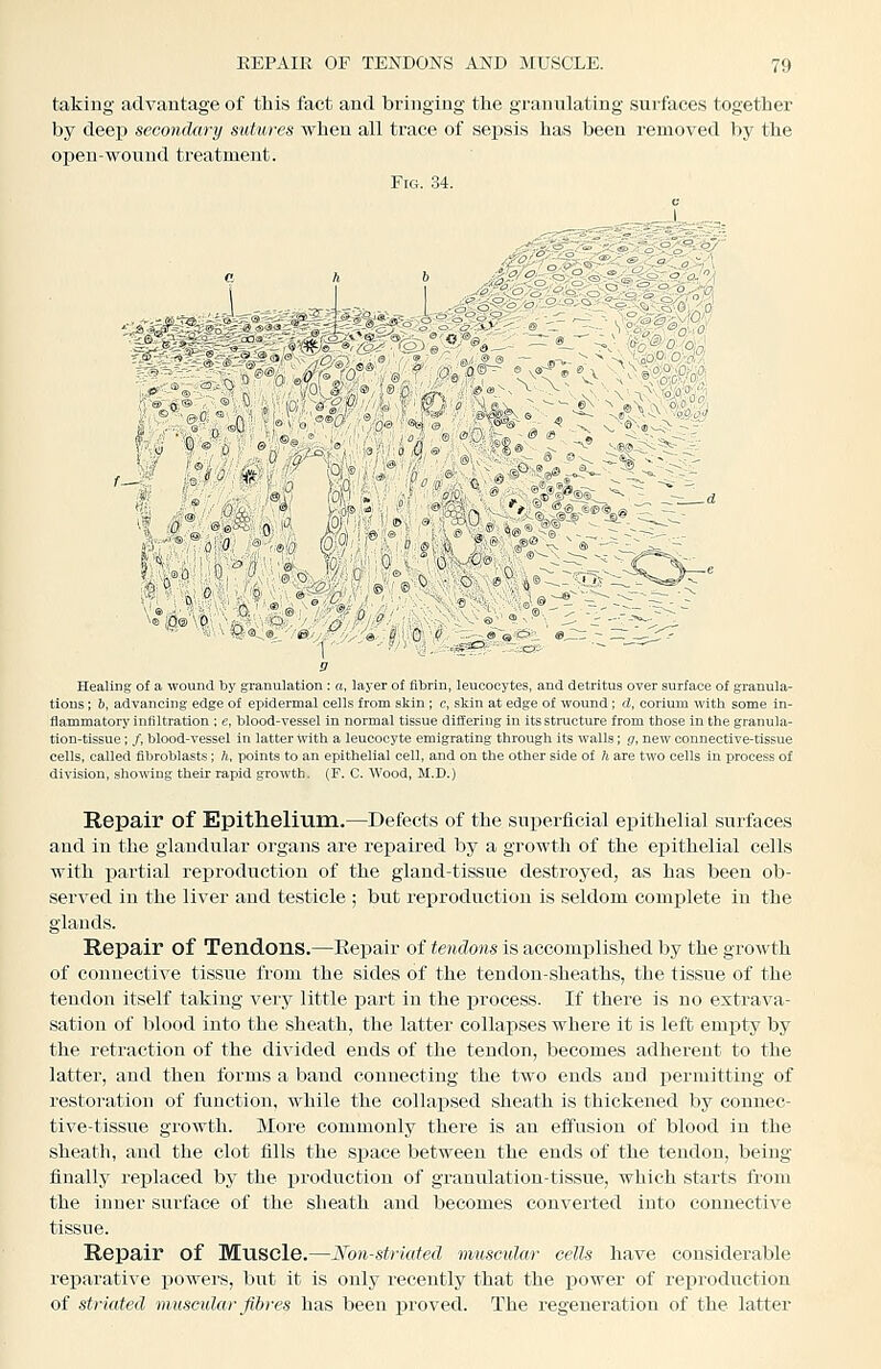 takiug advantage of this fact and bringing tlie granulating surfaces together by deep secondary sutures when all trace of sepsis has been removed by the oiDeu-wouud treatment. Fic4. 34. \ X Healing of a wound by granulation: a, layer of iilDrin, leucocytes, and detritus over surface of granula- tions ; 6, advancing edge of epidermal cells from skin; c, skin at edge of wound; d, corium with some in- flammatory infiltration ; e, blood-vessel in normal tissue differing in its structure from those in the granula- tion-tissue ; /, blood-vessel in latter with a leucocyte emigrating through its walls; g, new connective-tissue cells, called fibroblasts ; h, points to an epithelial cell, and on the other side of h are two cells in process of division, showing their rapid growth. (F. C. Wood, M.D.) Repair of Epithelium.—Defects of the superficial epithelial surfaces and in the glandular organs are repaired by a growth of the epithelial cells with partial reproduction of the gland-tissue destroyed, as has been ob- served in the liver and testicle ; but reproduction is seldom complete in the glands. Repair of Tendons.—Eepair of tendons is accomplished by the growth of connective tissue from the sides of the tendon-sheaths, the tissue of the tendon itself taking very little part in the process. If there is no extrava- sation of blood into the sheath, the latter collax)ses where it is left emjity by the retraction of the divided ends of the tendon, becomes adherent to the latter, and then forms a band connecting the two ends and permitting of restoration of function, while the collapsed sheath is thickened by connec- tive-tissue growth. More commonly there is an effusion of blood in the sheath, and the clot fills the space between the ends of the tendon, being finally replaced by the production of granulation-tissue, which starts from the inner surface of the sheath and becomes converted into connective tissue. Repair of Muscle.—Non-striated muscular cells have considerable reparative powers, but it is ouly recently that the power of reproduction of striated muscidar fibres has been jjroved. The regeneration of the latter