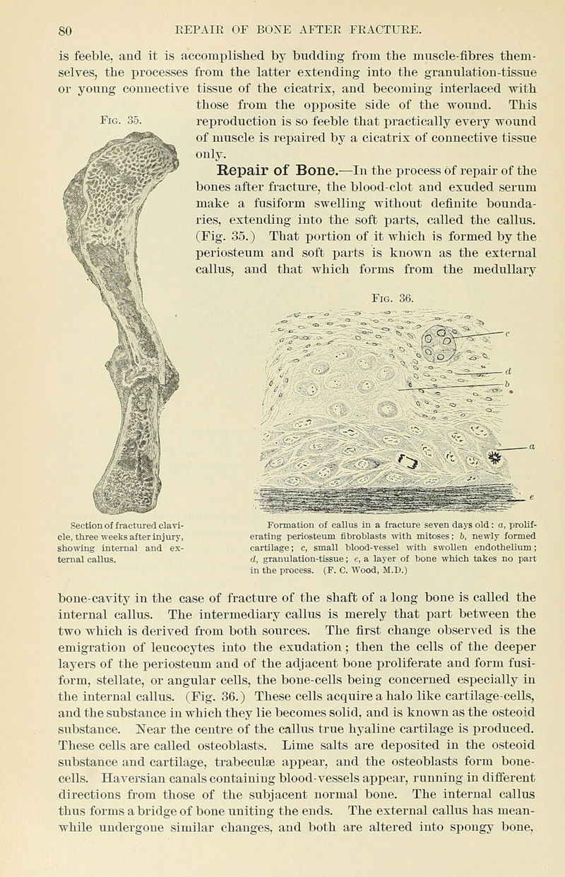 is feeble, and it is accomplislied by budding from the muscle-fibres them- selves, the processes from the latter extending into the granulation-tissue or young connective tissue of the cicatrix, and becoming interlaced -with those from the opposite side of the wound. This reproduction is so feeble that practically every wound of muscle is repaired by a cicatrix of connective tissue only. Repair of Bone.—In the process of repair of the bones after fracture, the blood-clot and exuded serum make a fusiform swelling without definite bounda- ries, extending into the soft parts, called the callus. (Pig. 35.) That portion of it which is formed by the periosteum and soft parts is known as the external callus, and that which forms from the medullary Fig. 36. ^i' Section of fractured clavi- cle, three weeks after injury, showing internal and ex- ternal callus. ^> Formation of callus in a fracture seven days old : a, prolif- erating periosteum fibroblasts with mitoses; &, newly formed cartilage; c, small blood-vessel with swollen endothelium; d, granulation-tissue; e, a layer of bone which takes no part in the process. (F. C. Wood, M.D.) bone-cavity in the case of fracture of the shaft of a long bone is called the internal callus. The intermediary callus is merely that part between the two which is derived from both sources. The first change observed is the emigration of leucocytes into the exudation; then the cells of the deeper layers of the periosteum and of the adjacent bone proliferate and form fusi- form, stellate, or angular cells, the bone-cells being concerned especially in the internal callus. (Fig. 36.) These cells acquire a halo like cartilage-cells, and the substance in which they lie becomes solid, and is known as the osteoid substance. Near the centre of the callus true hyaline cartilage is produced. These cells are called osteoblasts. Lime salts are dexjosited in the osteoid substance and cartilage, trabeculse appear, and the osteoblasts form bone- cells. Haversian canals containing blood-vessels appear, running in different directions fi'om those of the subjacent normal bone. The internal callus thus forms a bridge of bone uniting the ends. The external callus has mean- while undergone similar changes, and both are altered into spongy bone.