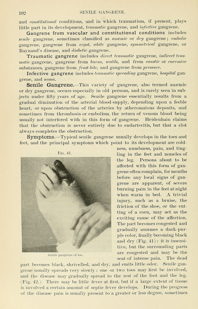 and constitutional couditious, and in whicli traumatism, if present, plays little part in its development, traumatic gangrene, and infective gangrene. Gangrene from vascular and constitutional conditions includes senile gangrene, sometimes classified as anaemic or dry gangrene; embolic gangrene, gangrene from ergot, white gangrene, symmetrical gangrene, or Eaj-naud's disease, and diabetic gangrene. Traumatic gangrene includes direct traumatic gangrene, indirect trau- matic gangrene, gangrene from burns, scalds, and from caustic or corrosive substances, gangrene from frost-bite, and gangrene from pressure. Infective gangrene includes traumatic spreading gangrene, hospital gan- grene, and noma. Senile Gangrene.—This variety of gangrene, also termed ansemic or dry gangrene, occurs especially in old persons, and is rarely seen in sub- jects under fifty years of age. Senile gangrene essentially results from a gradual diminution of the arterial blood-supply, depending u]3on a feeble heart, or upon obstruction of the arteries by atheromatous deposits, and sometimes from thrombosis or embolism, the return of venous blood being usually not interfered with in this form of gangrene. Heidenhain claims that the obstruction is never entirely due to endarteritis, but that a clot always comj^letes the obstruction. Symptoms.—Typical senile gangrene usually develops in the toes and feet, and the principal symptoms which point to its development are cold- ness, numbness, pain, and ting- Fi°- ■*!• ling in the feet and muscles of the leg. Persons about to be affected with this form of gan- grene often complain, for months before any local signs of gan- grene are apparent, of severe burning pain in the feet at night when warm in bed. A trivial injury, such as a bruise, the friction of the shoe, or the cut- ting of a corn, may act as the exciting cause of the affection. The part becomes congested and gradually assumes a dark-pur- ]3le color, finally becoming black and dry (Fig. 41) : it is insensi- tive, but the surrounding parts are congested and may be the seat of intense pain. The dead part becomes black, shrivelled, and dry, and emits little odor. Senile gan- grene usually spreads very slowly : one or two toes may first be involved, and the disease may gradually spread to the rest of the foot and the leg. (Fig. 42.) There may be little fever at first, but if a large extent of tissue is involved a certain amount of septic fever develops. During the progress of the disease pain is usually present to a greater or less degree, sometimes Senile gangrene ot toe.