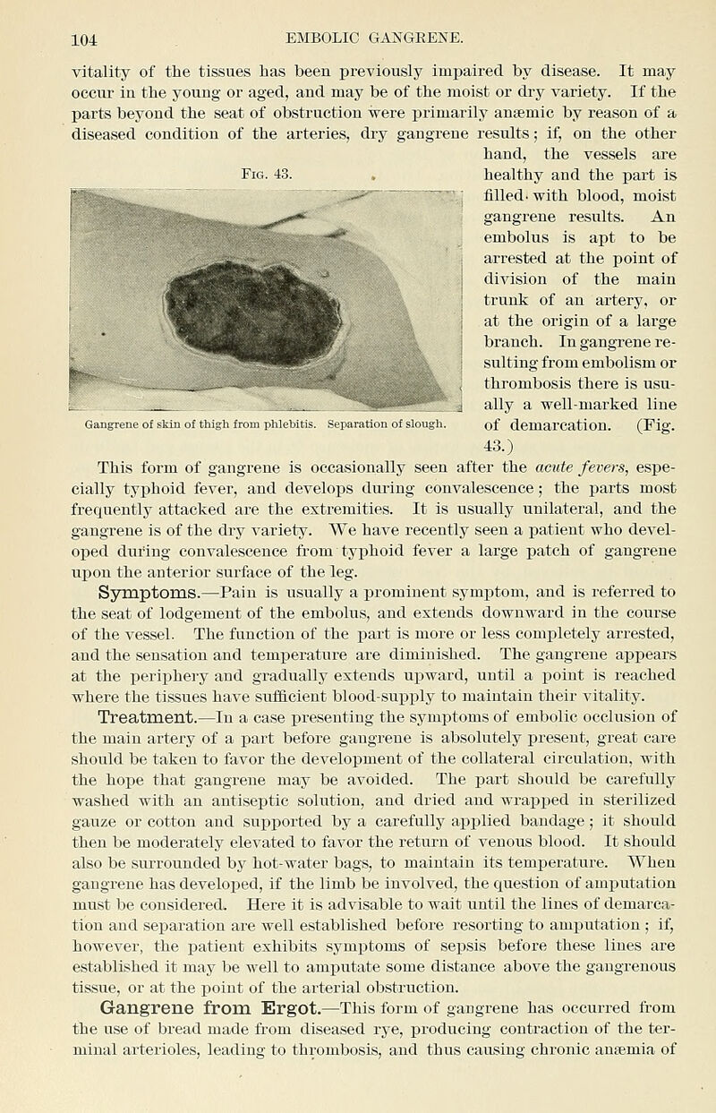 vitality of the tissues has been previously imjaaired by disease. It may occur in the young or aged, and may be of the moist or dry variety. If the parts beyond the seat of obstruction were primarily antemic by reason of a diseased condition of the arteries, dry gangrene resiilts; if, on the other hand, the vessels are Fig. 43. . healthy and the part is 'j filled, with blood, moist gangrene results. An embolus is apt to be arrested at the point of division of the main I trunk of an artery, or I at the origin of a large I branch. In gangrene re- i suiting from embolism or ; thrombosis there is usu- j ally a well-marked line Gangrene of skin of thigh from phlebitis Separation of slough of demarcation. (Fig. 43.) This form of gangrene is occasionally seen after the acute fevers, espe- cially typhoid fever, and develops during convalescence; the parts most frequently attacked are the extremities. It is usually unilateral, and the gangrene is of the dry variety. We have recently seen a patient who devel- oped during convalescence from typhoid fever a large patch of gangrene upon the anterior surface of the leg. Symptoms.—Pain is usually a prominent sj'mj)tom, and is referred to the seat of lodgement of the embolus, and extends downward in the course of the vessel. The function of the part is more or less completely arrested, and the sensation and temj)erature are diminished. The gangrene appears at the periphery and gradually extends upward, until a point is reached where the tissues have sufficient blood-supply to maintain their vitality. Treatment.—In a case presenting the symptoms of embolic occlusion of the main artery of a part before gangrene is absolutely present, great care should be taken to favor the development of the collateral circulation, with the hope that gangrene may be avoided. The part should be carefully washed with an antiseptic solution, and dried and wrapped in sterilized gauze or cotton and supported by a carefully applied bandage; it should then be moderately elevated to favor the return of venous blood. It should also be surrounded by hot-water bags, to maintain its temperature. When gangrene has developed, if the limb be involved, the question of amputation must be considered. Here it is advisable to wait until the lines of demarca- tion and separation are well established before resorting to amputation ; if, however, the patient exhibits symptoms of sepsis before these lines are established it may be well to amputate some distance above the gangrenous tissue, or at the point of the arterial obstruction. Gangrene from Ergot.—This form of gangrene has occurred from the use of bread made from diseased rye, producing contraction of the ter- minal arterioles, leading to thrombosis, and thus causing chronic anaemia of