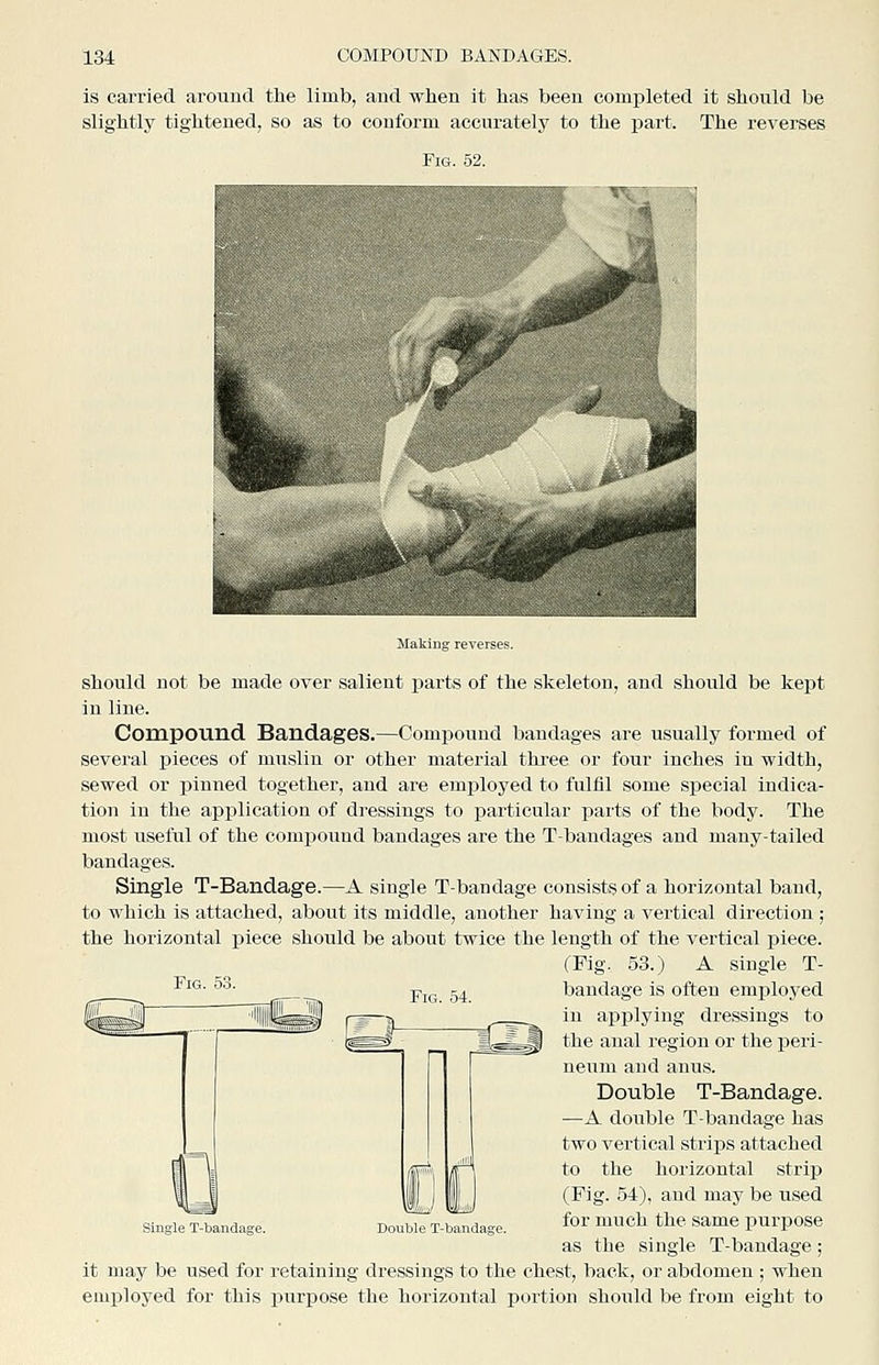 is carried around the limb, and when it has been completed it should be slightly tightened, so as to conform accurately to the part. The reverses Fig. 52. Halving reverses. should not be made over salient parts of the skeleton, and should be kept in line. Compound Bandages.—Compound bandages are usually formed of several pieces of muslin or other material three or four inches in width, sewed or pinned together, and are employed to fulfil some special indica- tion in the application of dressings to particular parts of the body. The most useful of the comjiouud bandages are the T-bandages and many-tailed bandages. Single T-Bandage.—A single T-bandage consists of a horizontal band, to which is attached, about its middle, another having a vertical direction ; the horizontal piece should be about twice the length of the vertical piece. (Fig. 53.) A single T- ^'- ■''•■ YiG 54 bandage is often employed in applying dressings to the anal region or the peri- neum and anu,s. Double T-Bandage. —A double T-bandage has two vertical strips attached to the horizontal strip (Fig. 54), and may be used for much the same purpose as the single T-bandage; it may be used for retaining dressings to the chest, back, or abdomen ; when employed for this purpose the horizontal portion should be from eight to Single T-bandage. Double T-bandage.