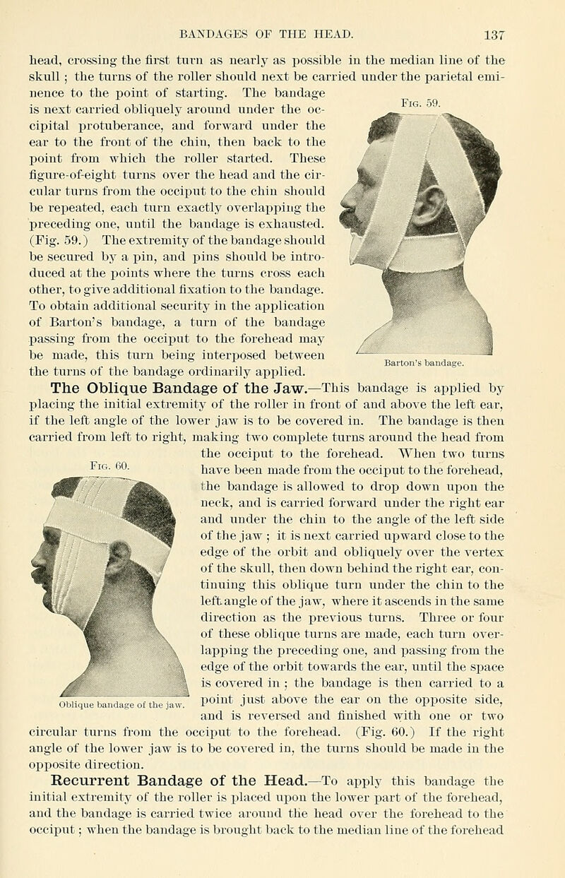 Fig. .59. \ Barton's bandage. head, crossing the first turn as nearly as possible in the median line of the skull; the turns of the roller should next be carried under the parietal emi- nence to the point of starting. The bandage is next carried obliquely around under the oc- ciiJital protuberance, and forward under the ear to the front of the chin, then back to the point from which the roller started. These figure-of-eight turns over the head and the cir- cular turns from the occiput to the chin should be repeated, each turn exactly overlapping the preceding one, until the bandage is exhausted. (Fig. 59.) The extremity of the bandage should be secured by a pin, and pins should be intro- duced at the points where the turns cross each other, to give additional fixation to the bandage. To obtain additional security in the aijplication of Barton's bandage, a turn of the bandage Ijassing from the occii^ut to the forehead may be made, this turn being interposed between the turns of the bandage ordinarily applied. The Oblique Bandage of the Jaw.—This bandage is applied by placing the initial extremity of the roller in front of and above the left ear, if the left angle of the lower jaw is to be covered in. The bandage is then carried from left to right, ]naking two complete turns around the head from the occiput to the forehead. When two turns have been made from the occiput to the forehead, the bandage is allowed to drop down upon the neck, and is carried forward under the right ear and under the chin to the angle of the left side of the jaw ; it is next carried upward close to the edge of the orbit and obliquely over the vertex of the skull, then down behind the right ear, con- tinuing this oblique turn under the chin to the leftaugie of the jaw, where it ascends in the same direction as the previous turns. Three or four of these oblique turns are made, each turn over- lapping the preceding one, and xsassing from the edge of the orbit towards the eai', until the space is covered in ; the bandage is then carried to a point just above the ear on the opposite side, and is reversed and finished with one or two circular turns from the occiput to the forehead. (Fig. 60.) If the right angle of the lower jaw is to be covered in, the turns should be made in the opposite direction. Recurrent Bandage of the Head.—To apply this bandage the initial extremity of the roller is i)laeed ui)ou the lower j)art of the forehead, and the bandage is carried twice around the head over the forehead to the occiput; when the bandage is brought back to the median line of the forehead Fig. 60. Oblique bandage of the ia\\