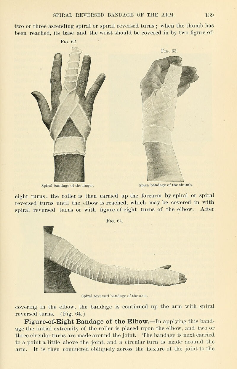 two or three ascending spiral or spiral reversed turns; wlien tlie thumb has been reached, its base and the wrist should be covered in by two figure-of- FiG. 63. Spiral bandage of the finger. Spica bandage ot the thumb. eight turns; the roller is then carried up the forearm by spiral or spiral reversed 'turns until the elbow is reached, which may be covered in with spiral reversed turns or with figure-of-eight turns of the elbow. After Spiral reversed bandage o£ the arm. covering in the elbow, the bandage is continued up the arm with spiral reversed tm-us. (Fig. 01.) Figure-of-Eight Bandage of the Elbow.—In applying this band- age the initial extremity of the roller is placed upon the elbow, and two or three circular turns are made around the joint. The bandage is next carried to a point a little above the joint, and a circular turn is made- around the arm. It is then conducted obliquely across the flexiire of the joint to the