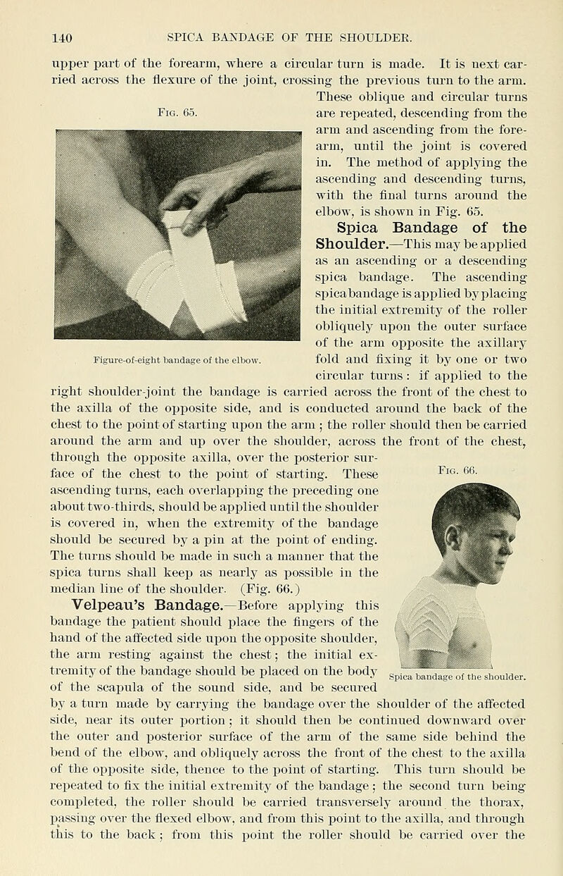 Figure-of-eight bandage of tlie elbow. upper part of the forearm, where a circular turn is made. It is next car- ried across the flexure of the joint, crossing the previous turn to the arm. These oblique and circular turns Fig. 65. are repeated, descending from the arm and ascending from the fore- arm, until the joint is covered in. The method of applying the ascending and descending turns, with the final turns around the elbow, is shown in Fig. 65. Spica Bandage of the Shoulder.—This may be applied as an ascending or a descending spica bandage. The ascending spica bandage is applied by placing the initial extremity of the roller obliquely upon the outer surface of the arm oijposite the axillary fold and fixing it by one or two circular turns: if applied to the right shoulder-joint the bandage is carried across the front of the chest to the axilla of the opposite side, and is conducted around the back of the chest to the point of starting upon the arm ; the roller should then be carried around the arm and up over the shoulder, across the front of the chest, through the opposite axilla, over the posterior sur- face of the chest to the point of starting. These ascending turns, each overlapping the preceding one about two-thirds, should be applied until the shoulder is covered in, when the extremity of the bandage should be secured by a pin at the point of ending. The turns should be made in such a manner that the spica turns shall keep as nearly as possible in the median line of the shoulder. (Fig. 66.) Velpeau's Bandage.—Before applying this bandage the patient should place the fingers of the hand of the affected side upon the opposite shoulder, the arm resting against the chest; the initial ex- tremity of the bandage should be placed on the body of the scai^ula of the sound side, and be secured by a turn made by carrying the bandage over the shoulder of the affected side, near its outer portion; it should then be continued downward over the outer and posterior surface of the arm of the same side behind the bend of the elbow, and obliquely across the front of the chest to the axilla of the opposite side, thence to the point of starting. This turn should be repeated to fix the initial extremity of the bandage; the second turn being- completed, the roller should be carried transversely around the thorax, passing over the flexed elbow, and from this point to the axilla, and through this to the back; froDi this point the roller should be carried over the * Spica bandage of tiie sliouider.