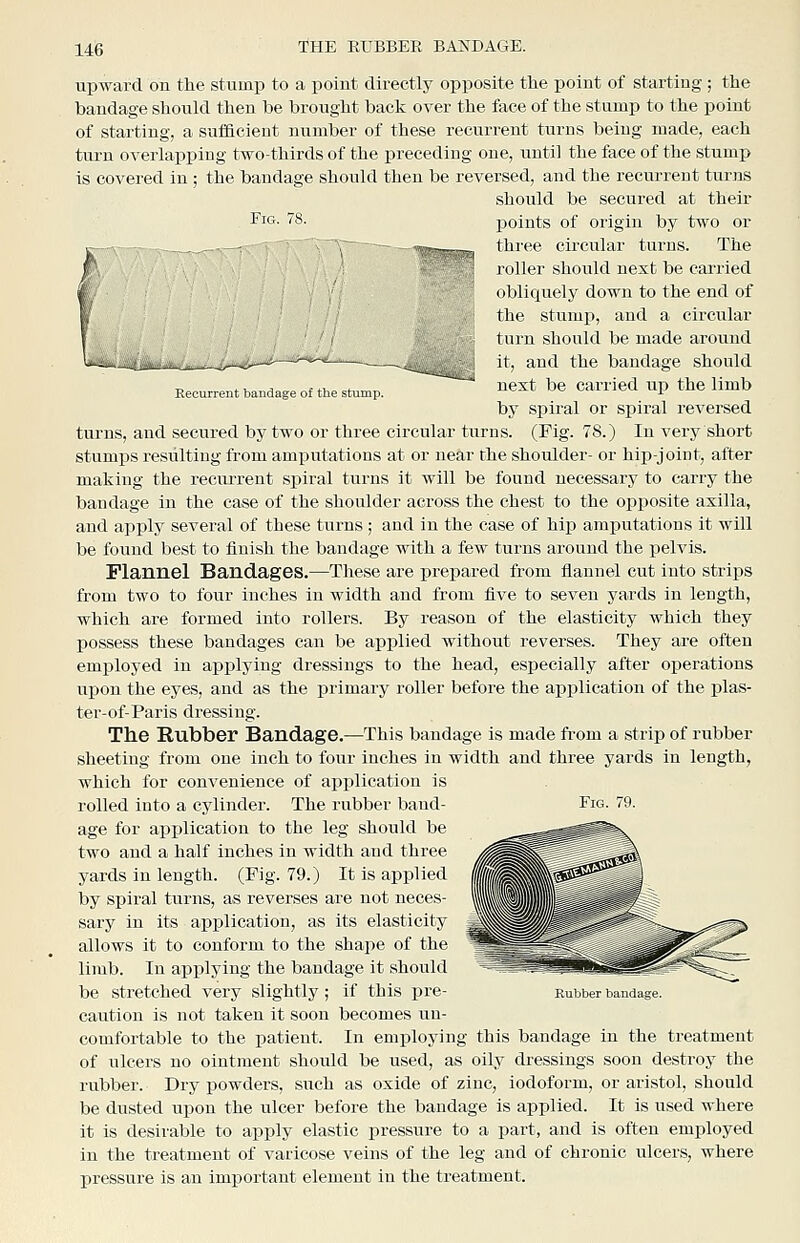 Recurrent bandage of the stump. upward on the stump to a point directly opposite tlie point of starting; the bandage should then be brought back over the face of the stump to the point of starting, a sufficient number of these recurrent turns being made, each turn overlapping two-thirds of the preceding one, until the face of the stump is covered in ; the bandage should then be reversed, and the recurrent turns should be secured at their ^iG. 78. points of origin by two or thi'ee circular turns. The roller should next be carried oblicxuely down to the end of the stumf), and a circular turn should be made around it, and the bandage should nest be carried up the limb by spiral or sjjiral reversed turns, and secured by two or three circular turns. (Fig. 78.) In very short stumps resulting from amputations at or near the shoulder- or hip-joint, after making the recurrent spiral turns it will be found necessary to carry the bandage in the case of the shoulder across the chest to the opposite axilla, and applj^ several of these turns ; and in the case of hip amputations it will be found best to finish the bandage with a few turns around the pelvis. Flannel Bandages.—These are prepared from flannel cut into strips from two to four inches in width and from five to seven yards in length, which are formed into rollers. By reason of the elasticity which they possess these bandages can be applied without reverses. They are often employed in applying dressings to the head, especially after operations uijon the eyes, and as the primary roller before the application of the plas- ter-of-Paris dressing. The Rubber Bandage.—This bandage is made from a strip of rubber sheeting from one inch to four inches in width and three yards in length, which for convenience of application is rolled into a cylinder. The rubber band- Fig. 79. age for application to the leg should be two and a half inches in width and three yards in length. (Pig. 79.) It is applied by sijiral turns, as reverses are not neces- sary in its application, as its elasticity allows it to conform to the shape of the limb. In applying the bandage it should be stretched very slightly ; if this pre- Ruijber bandage. caution is not taken it soon becomes un- comfortable to the patient. In employing this bandage in the treatment of ulcers no ointment should be used, as oily dressings soon destroy the rubber. Dry powders, such as oxide of zinc, iodoform, or aristol, should be dusted upon the ulcer before the bandage is applied. It is used where it is desirable to apply elastic pressure to a part, and is often employed in the treatment of varicose veins of the leg and of chronic ulcers, where pressure is an important element in the treatment.