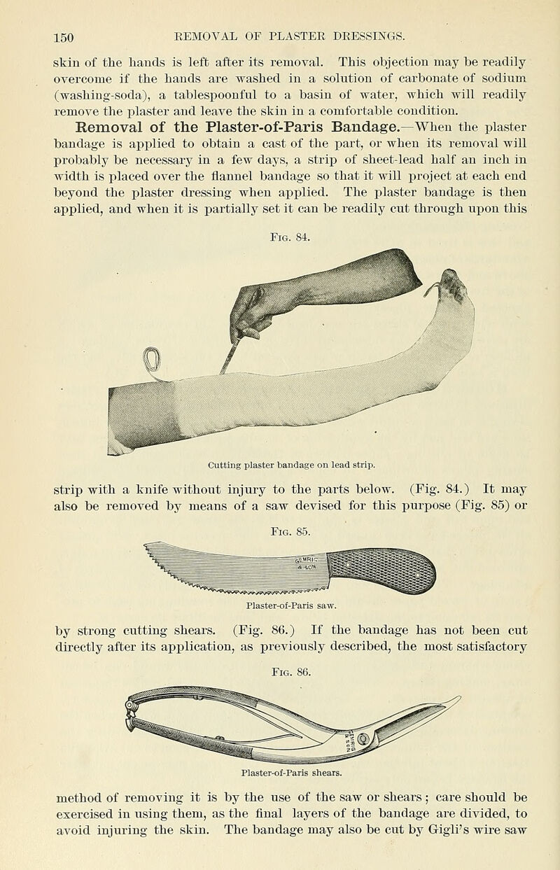 skin of the bauds is left after its removal. This objection may be readily overcome if the hands are washed in a solution of carbonate of sodium (washing-soda), a tablespoonful to a basin of water, which will readily remove the plaster and leave the skin in a comfortable condition. Removal of the Plaster-of-Paris Bandage.—When the plaster bandage is applied to obtain a cast of the part, or when its removal will probably be necessary in a few days, a strip of sheet-lead half an inch in width is placed over the flannel bandage so that it will project at each end beyond the plaster dressing when applied. The plaster bandage is then applied, and when it is partially set it can be readily cut through upon this Fig. 84. Cutting plaster bandage on lead strip. strip with a knife without injury to the parts below. (Fig. 84.) It may also be removed by means of a saw devised for this purpose (Fig. 85) or Fig. 85. ) Plaster-of-Paris saw. by strong cutting shears. (Fig. 86.) If the bandage has not been cut directly after its application, as previously described, the most satisfactory Fig. 86. Plaster-of-Paris shears. method of removing it is by the use of the saw or shears ; care should be exercised in using them, as the final layers of the bandage are divided, to avoid injuring the skin. The bandage may also be cut by Gigii's wire saw